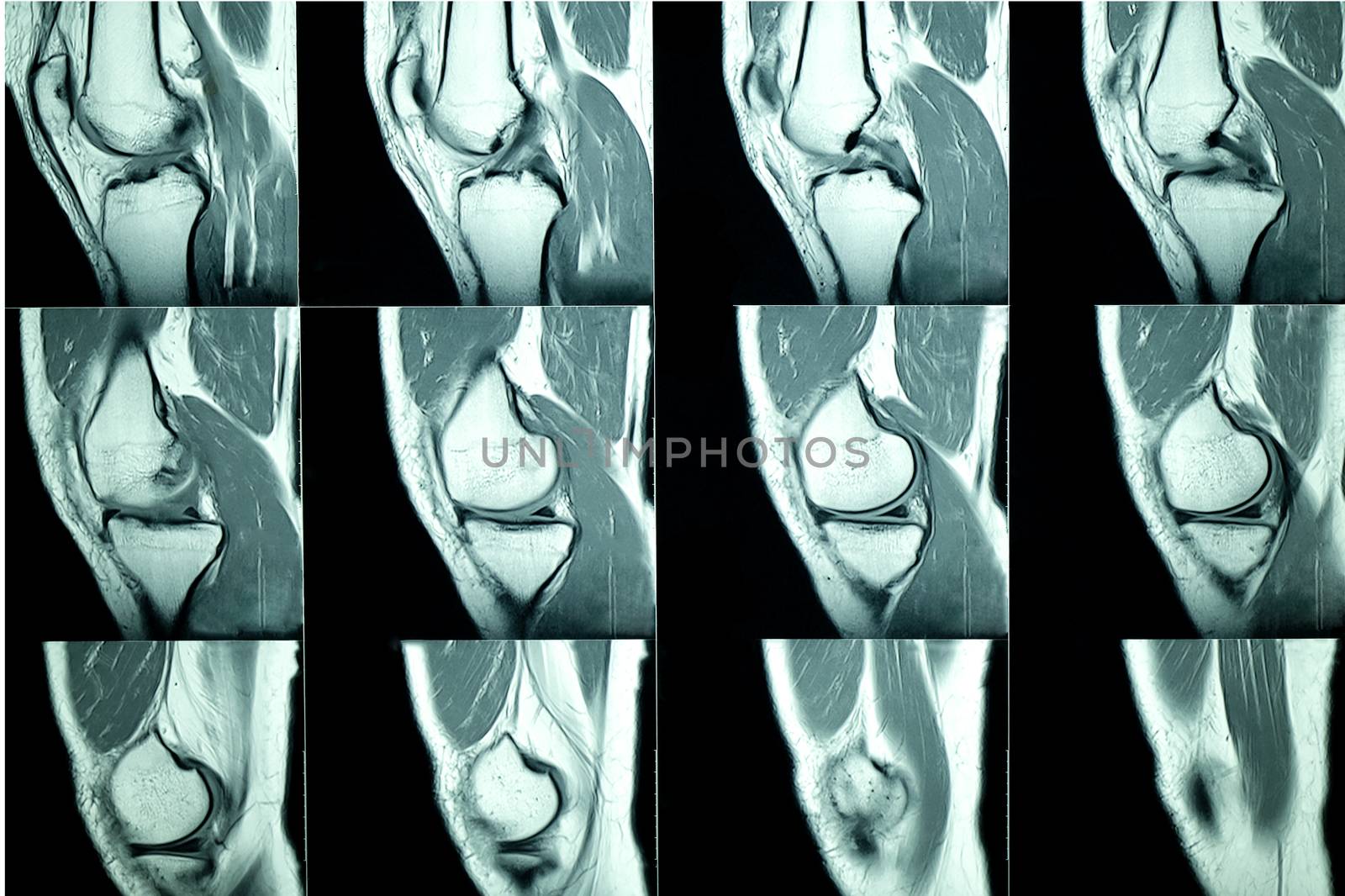 MRI scan of a male patient with a history of chronic knee pain