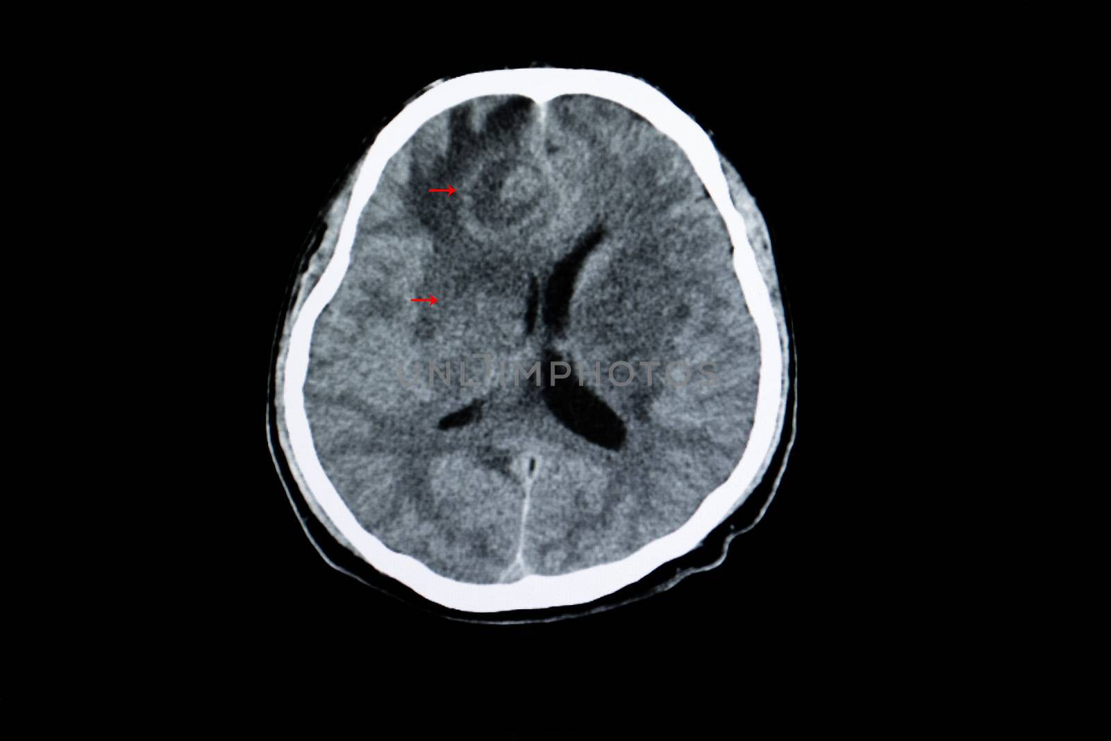 CT scan of a brain of an HIV patient with cerebral toxoplasma infection showing brain edema and ring enhancing lesion.