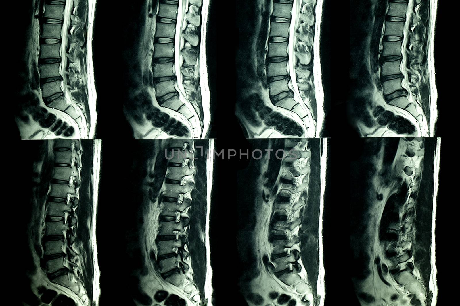 MRI scan of lumbar spines of a patient with chronic back pain showing degenerative change of lumbar and sacral spines with disc dessication and disc space narrowing and central bulging of L3-4 disc