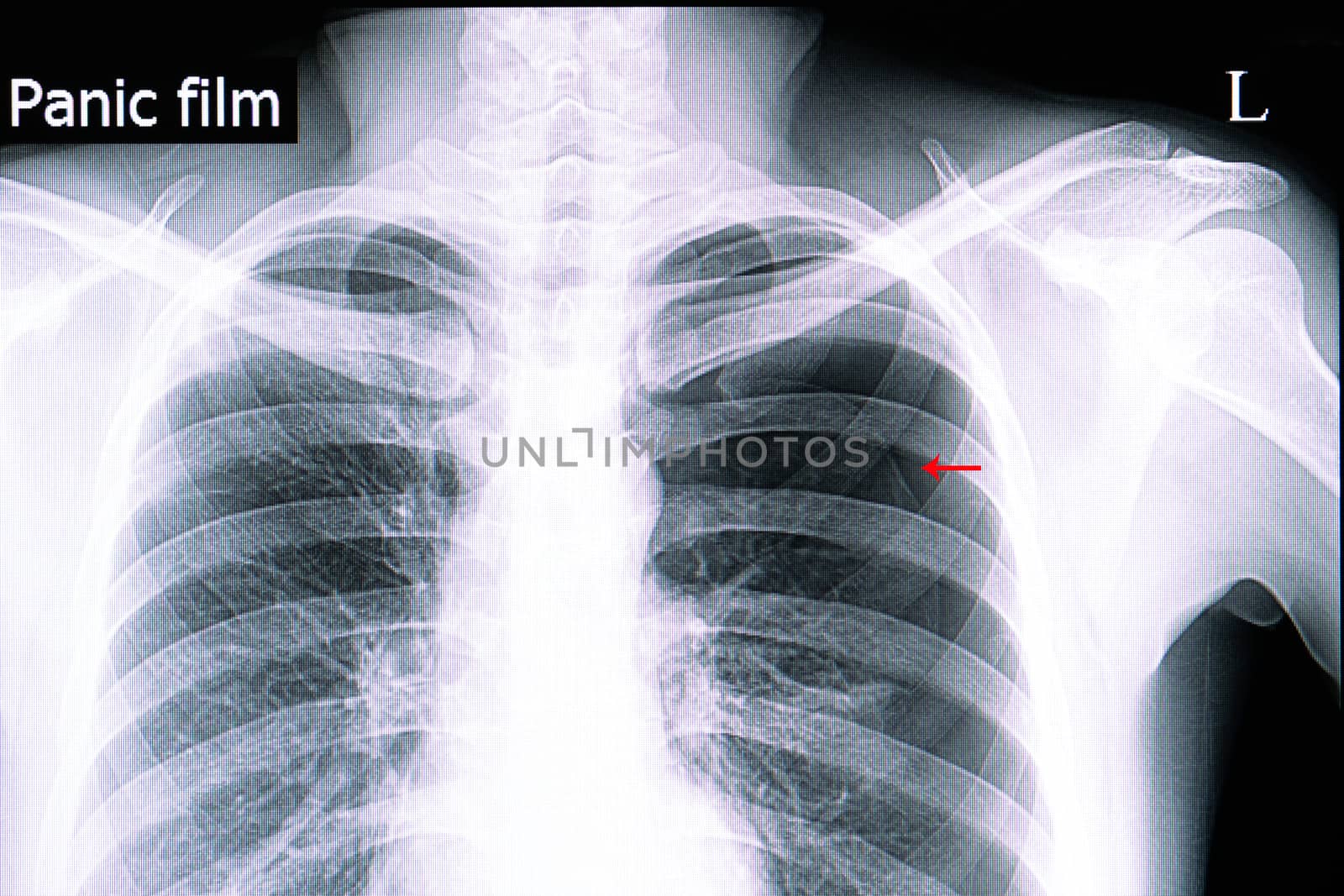Xray film of a patient with large left lung spontaneous pneumothorax with separation of visceral pleura from the parietal pleura seen as a thin line.