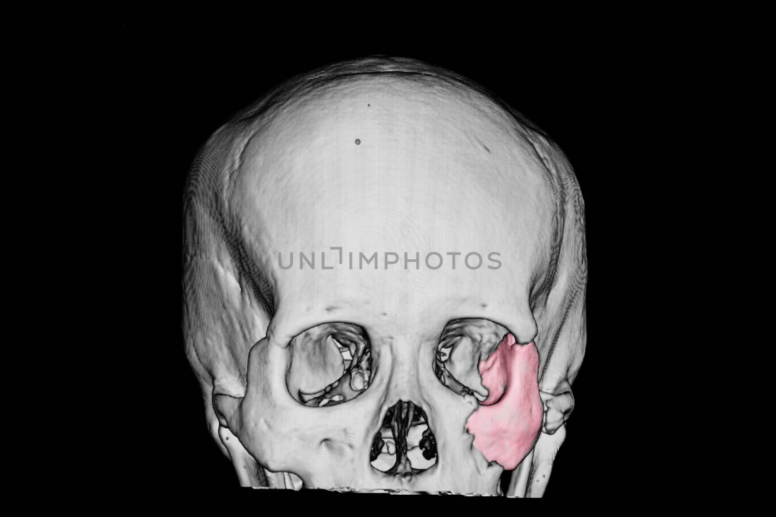 3-D redering film of a patient skull with traumatic brain injury showing fractured zygomatic bone (pink area)