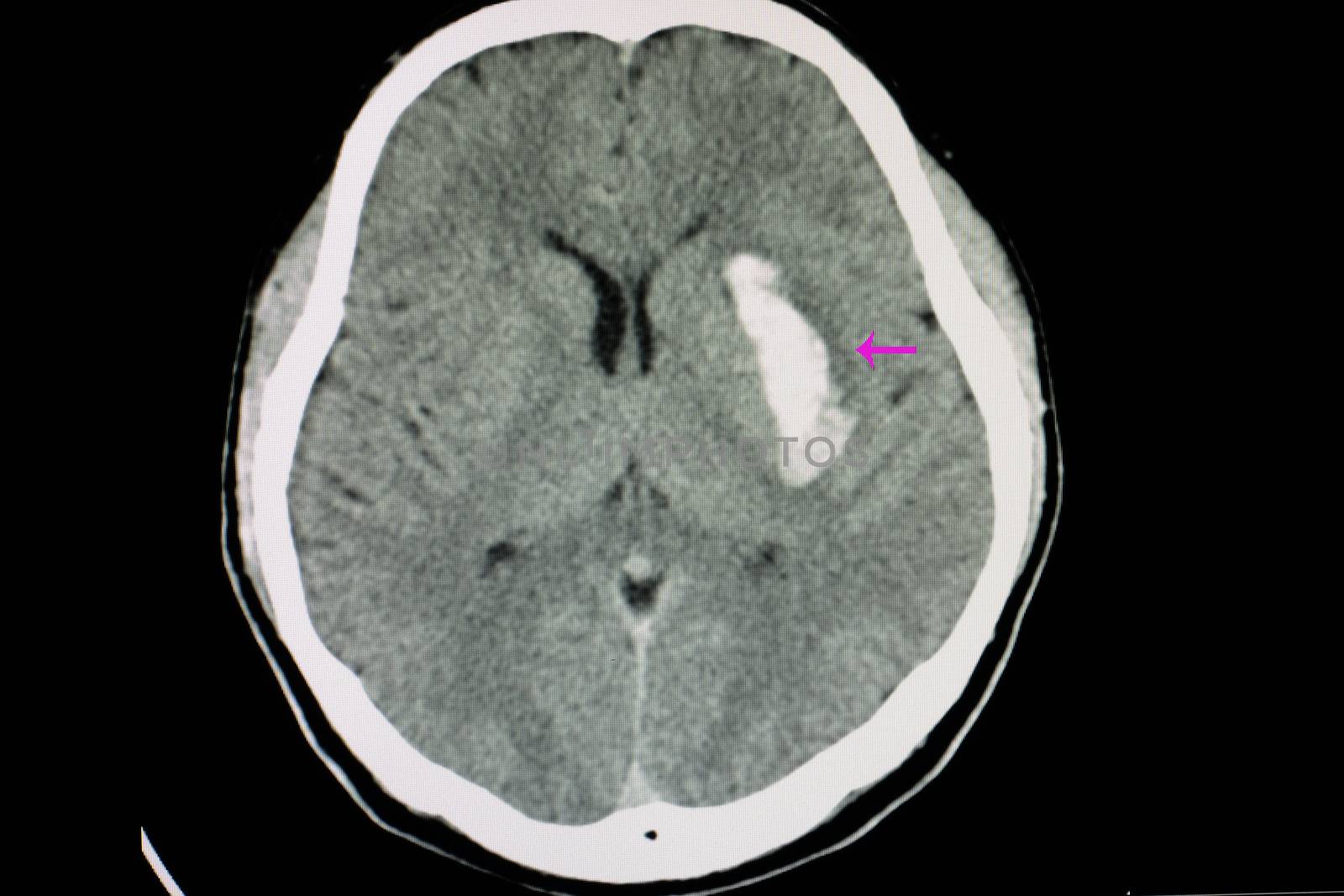 CT scan of a brain of a patient with intracerebral hemorrhage from stroke with bleeding in left internal capsule