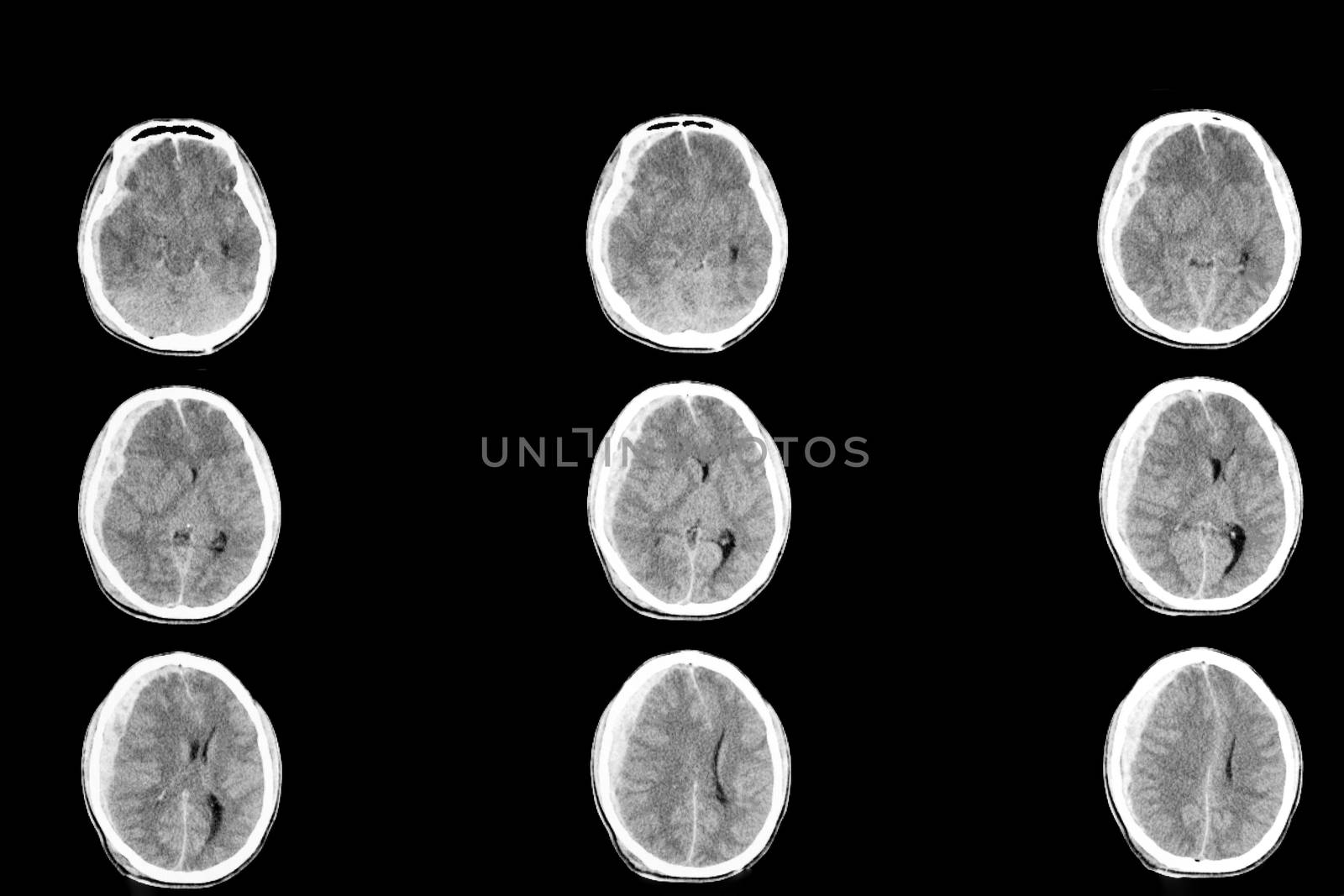 Cranial computer tomography or CT scan of a patient with traumatic brain injury showing right subdural hemorrhage and edema of cerebral hemisphere with shifting of falx cerebri to the left
