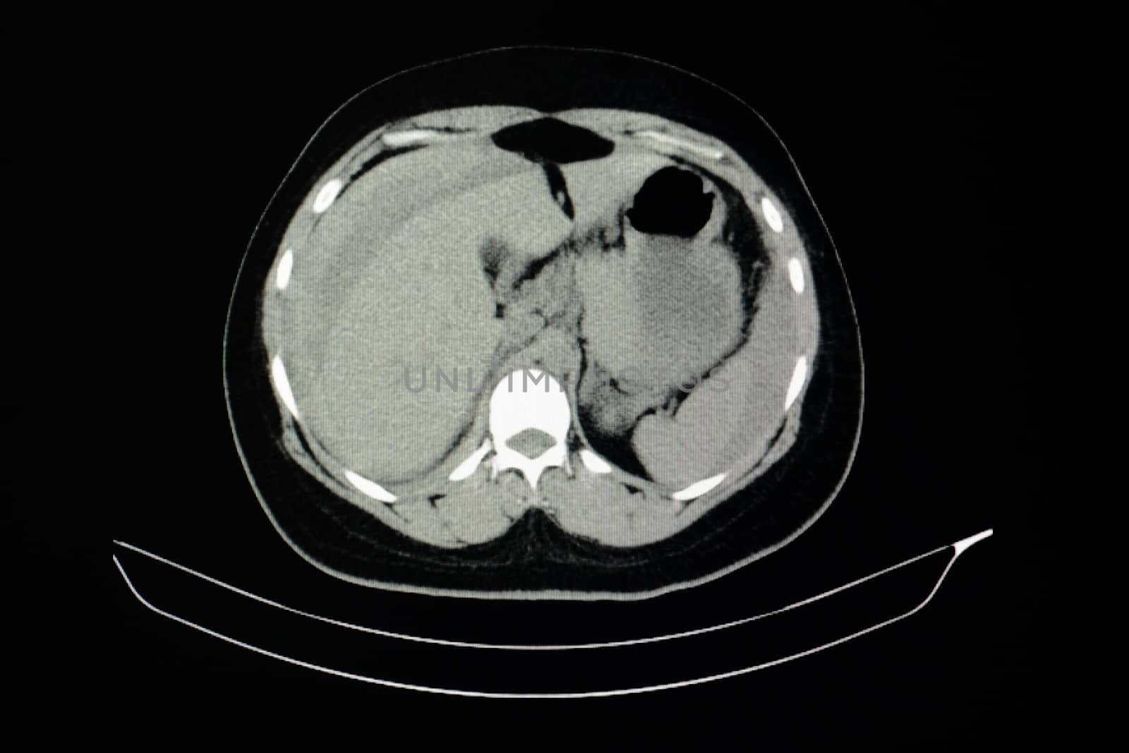 computer tomography scan of a tramatic patient with liver laceration and hemoperitonim