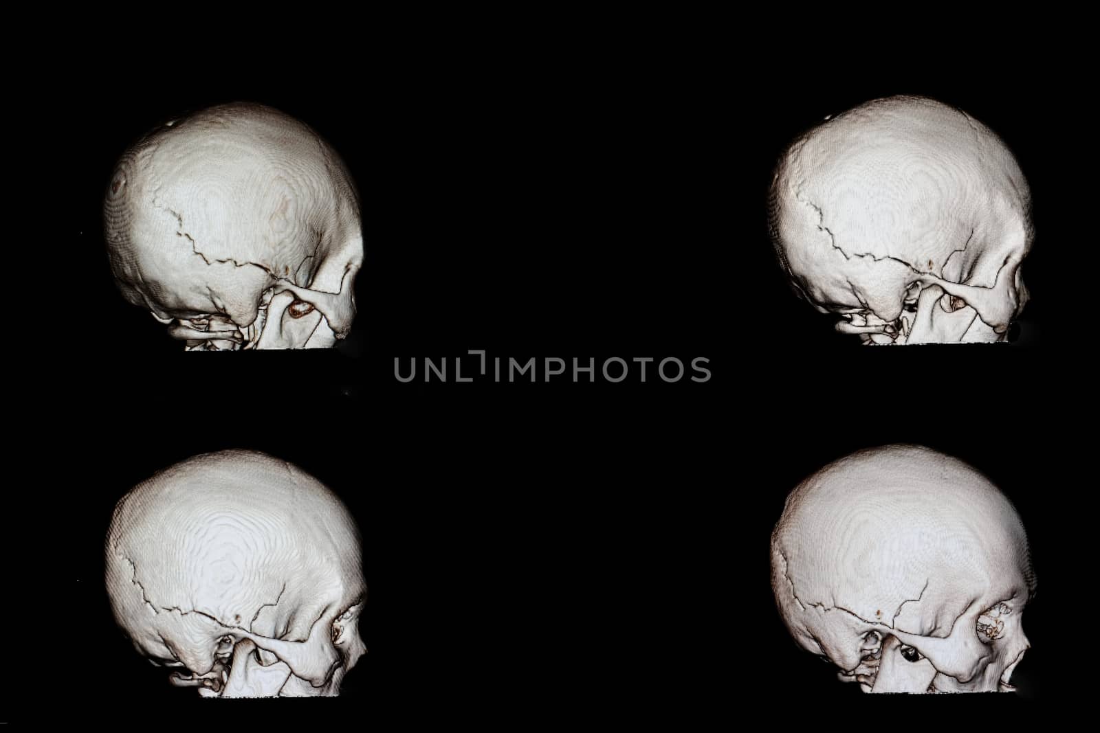3 d rendering of a skull of a patient with head injury who had fracture occipito-temporal bone of his cranium