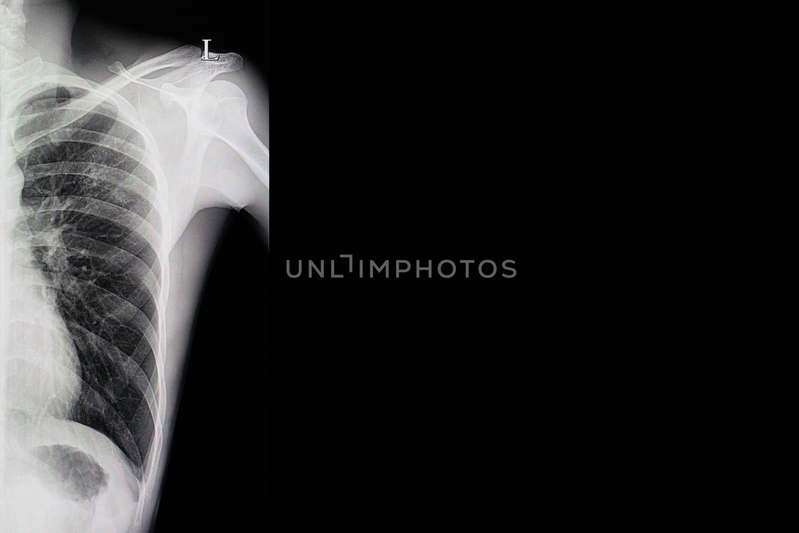 xray film of a patient with active pulmonary tuberculosis in the left upper lung