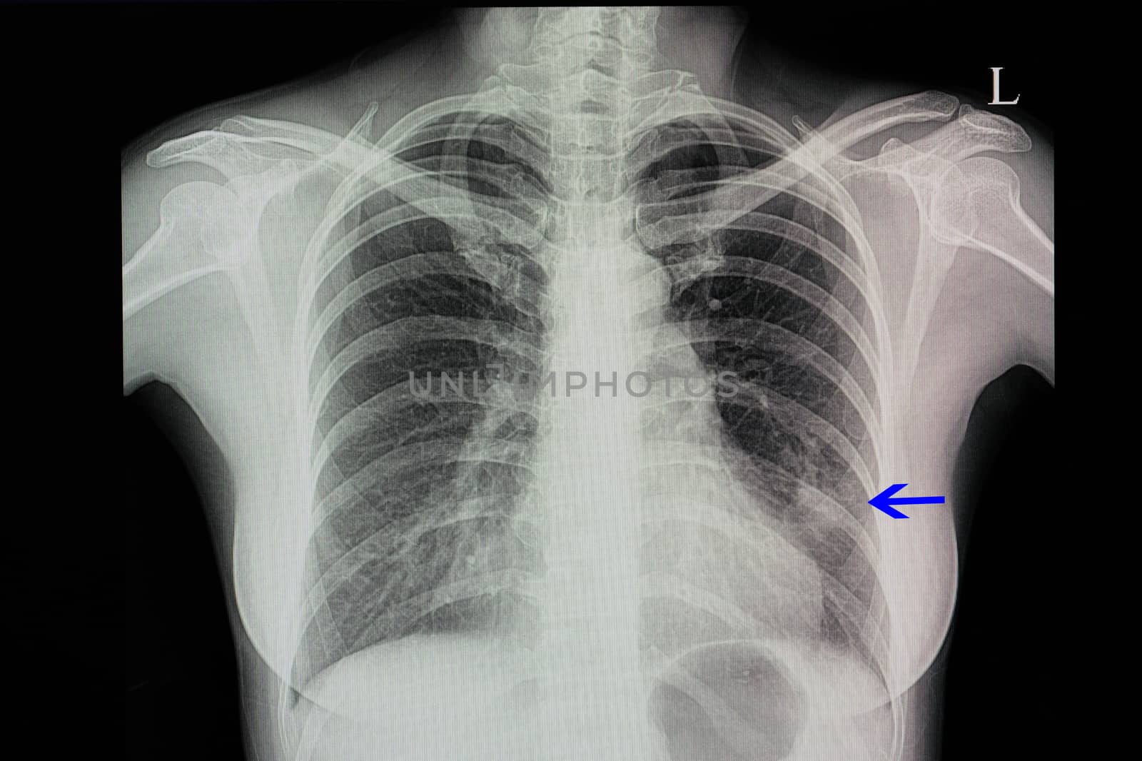 a chest x-ray of a patient with pneumonia with left lower lung infiltration