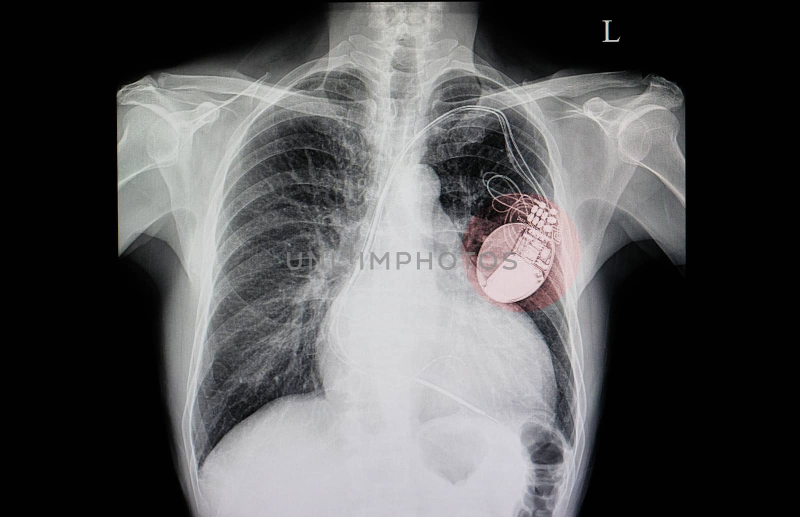 chest xray film of a patient with cardiac pacemaker, also with congestive heart and cardiomegaly