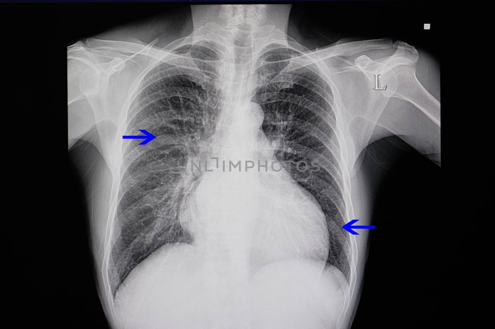 a chest x-ray of a patient with heart failure showing cardiomegaly and pulmonary congestion