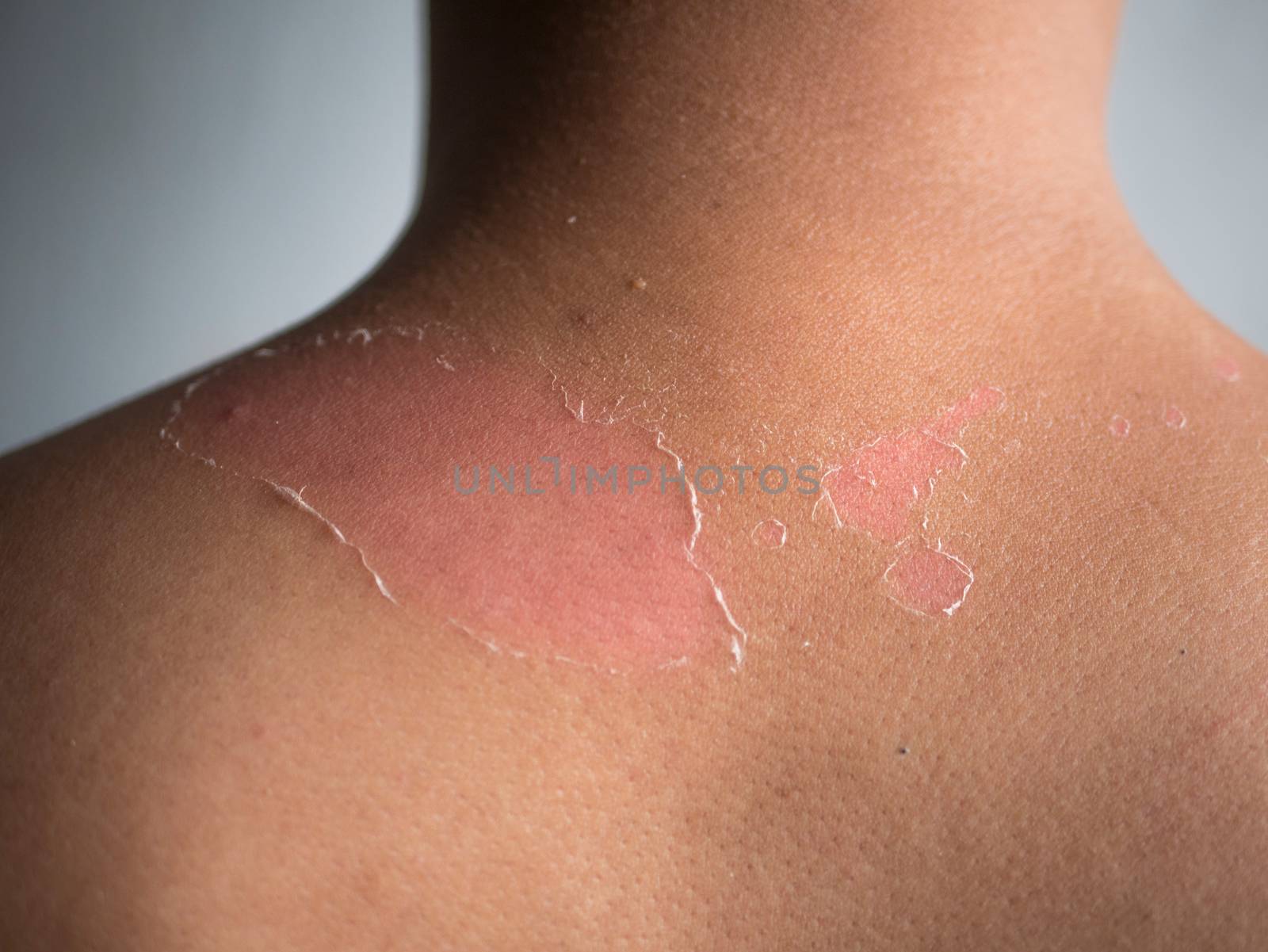 peeling skin at back and shoulder from sunburn effect on body of young man from sunbath at summer. dangerous sunburn concept by asiandelight