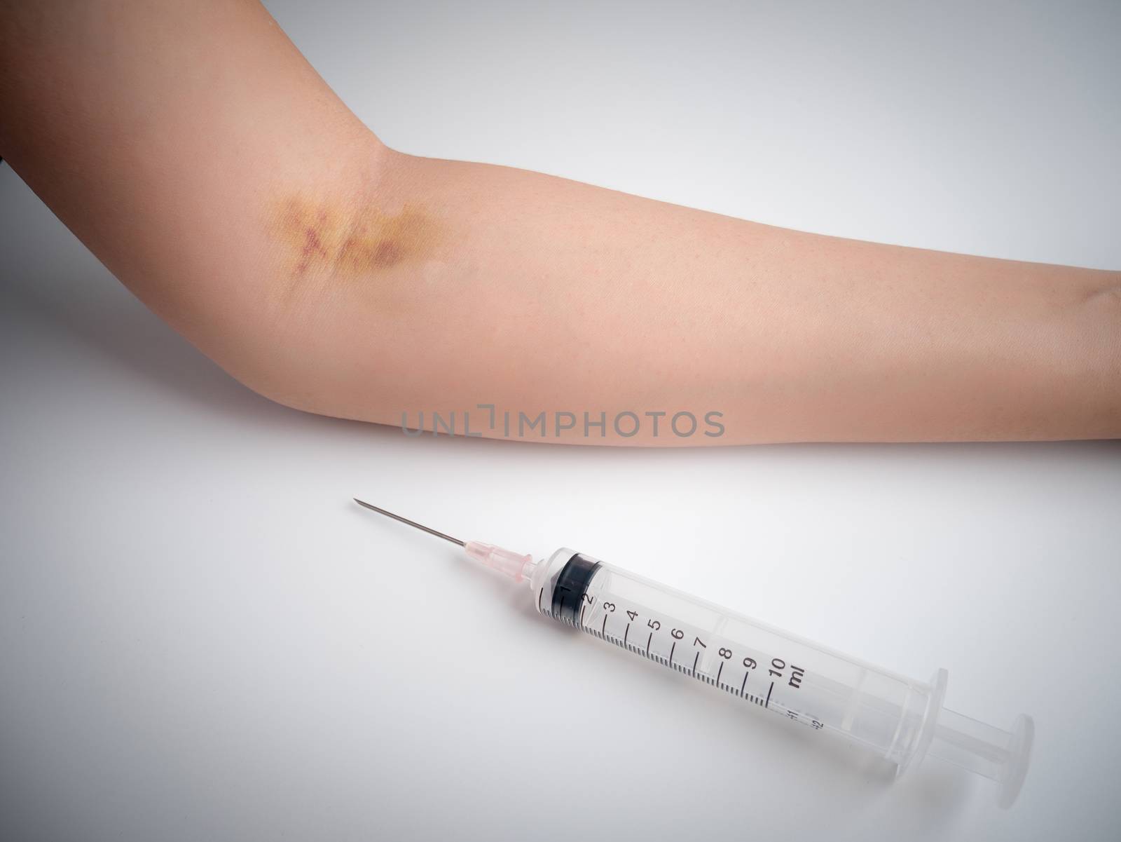 syringe , injection needle on the table and close up arm with bruise effect from frequent injection by asiandelight