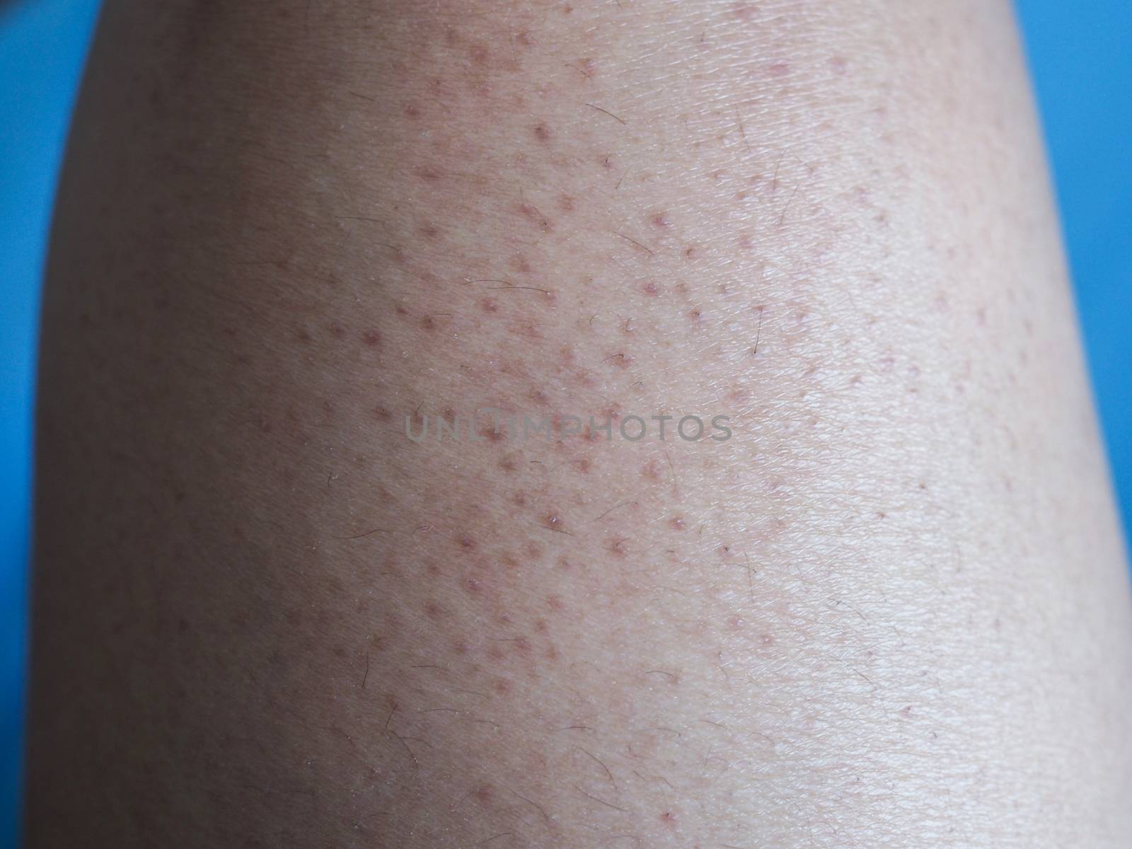 Problems of Body Skin, large pores and dark colors on legs.