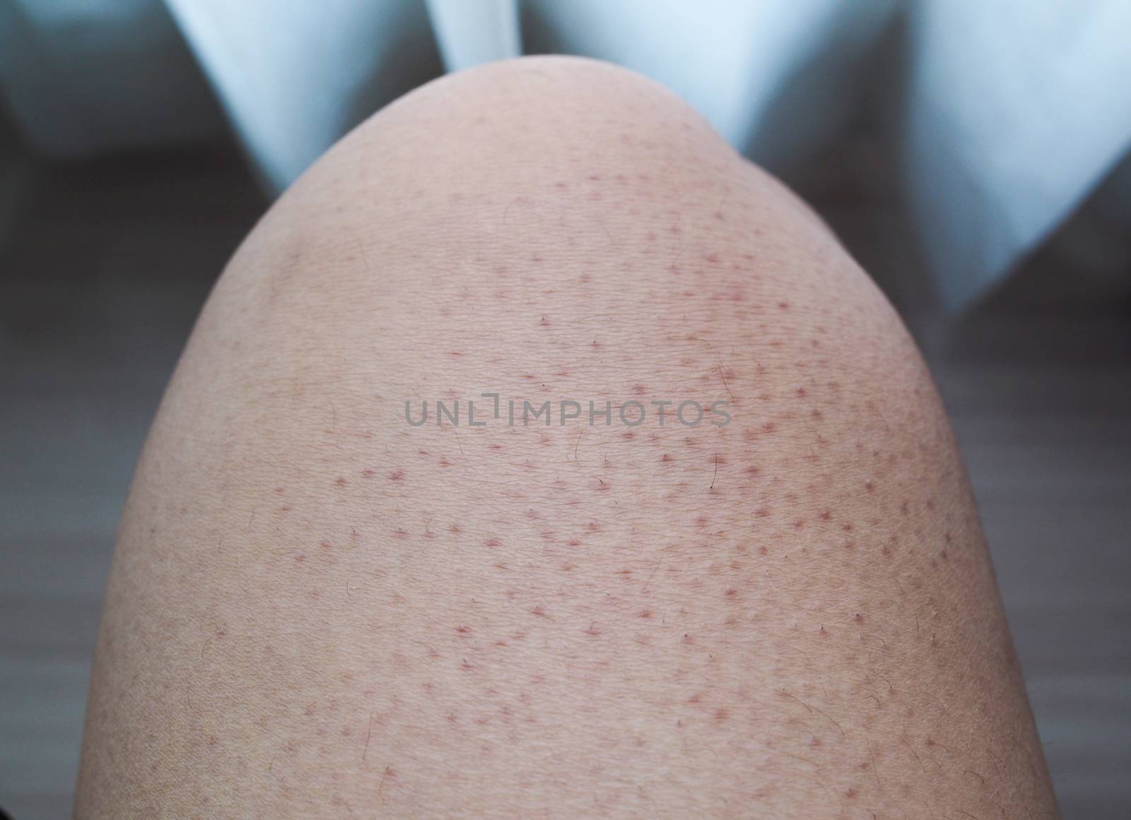 Problems of Body Skin, large pores and dark colors on legs. by kittima05