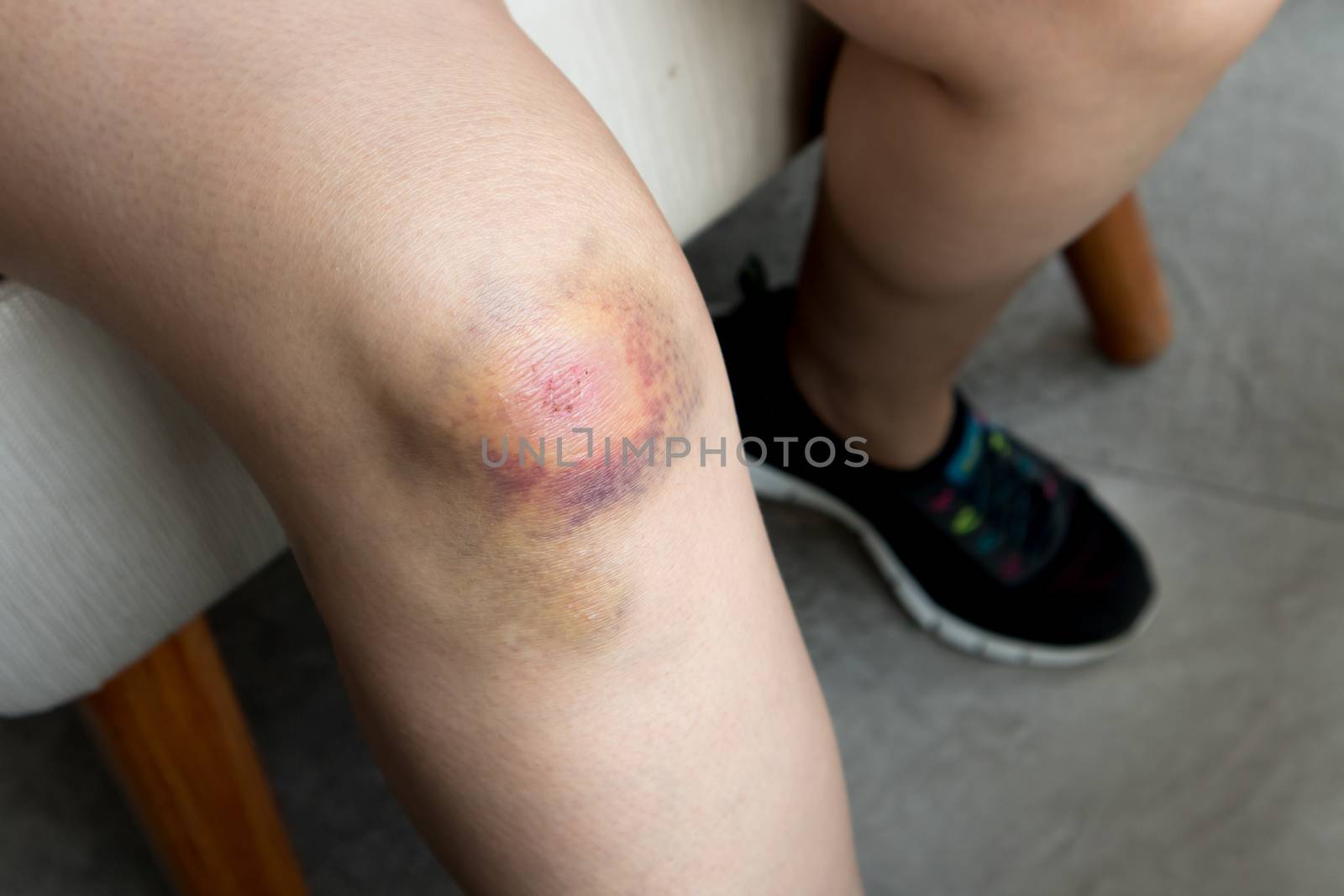 Woman with Bruise on knee from accident close up shot