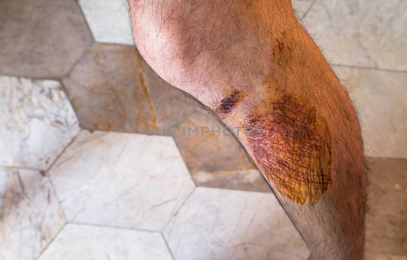 Close up of Man with scab wound on the leg