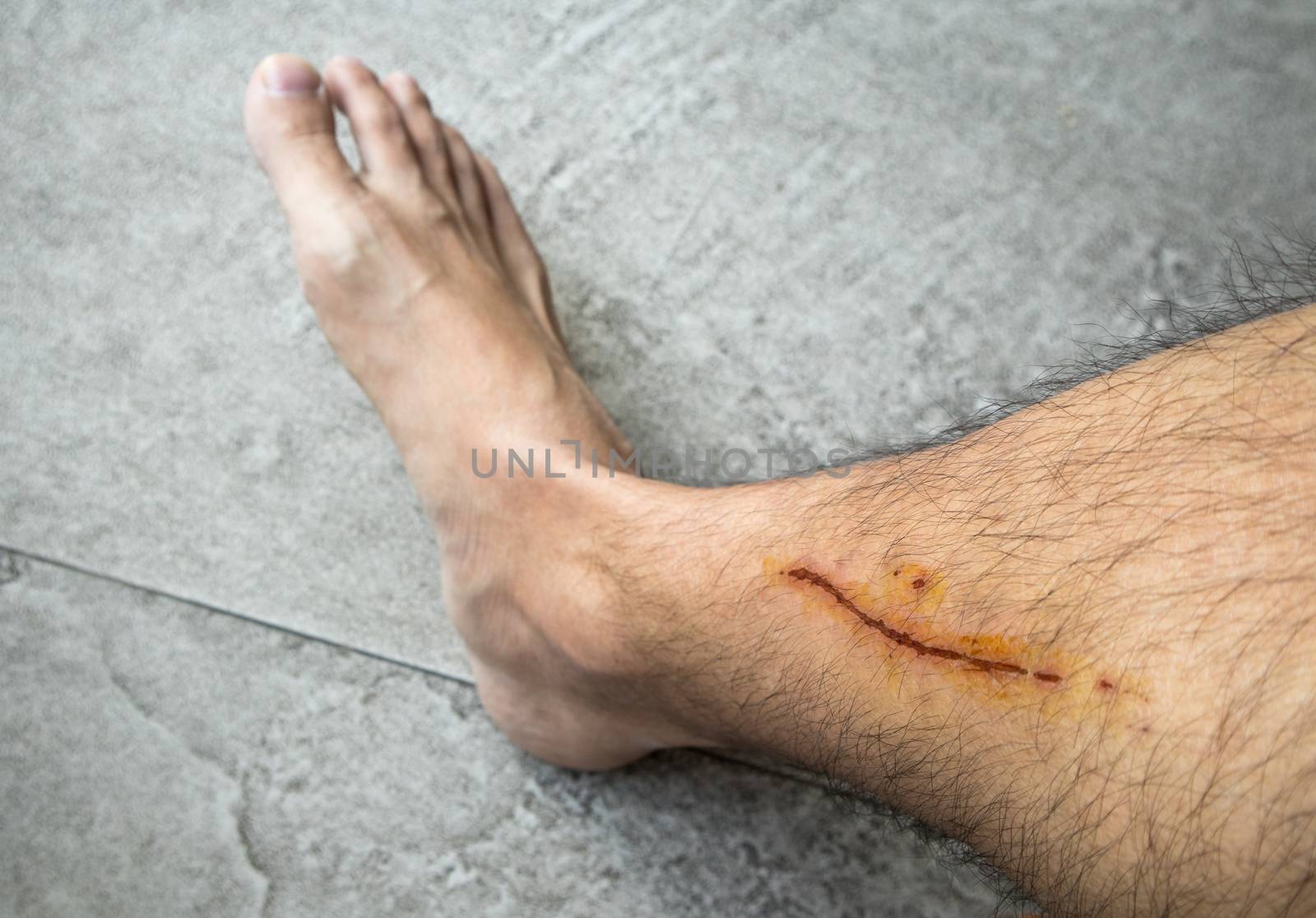 Man with long scab wound on his right leg close up shot bare foot