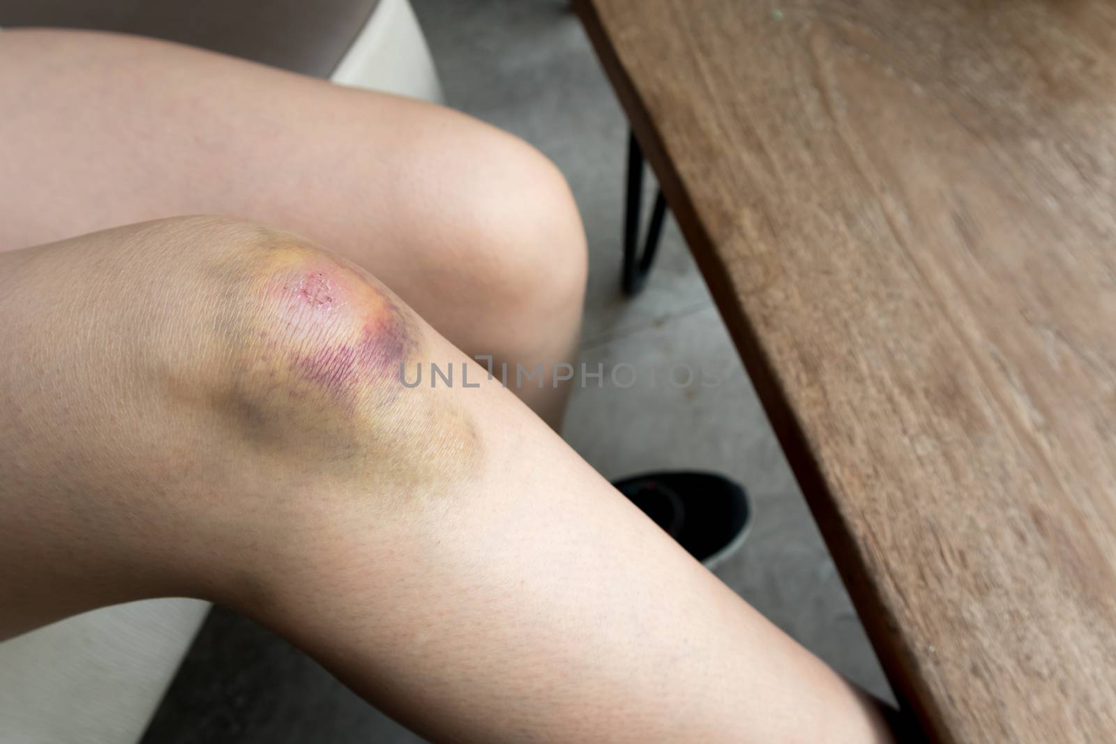 Woman with Bruise on knee from accident sitting on sofa close up shot