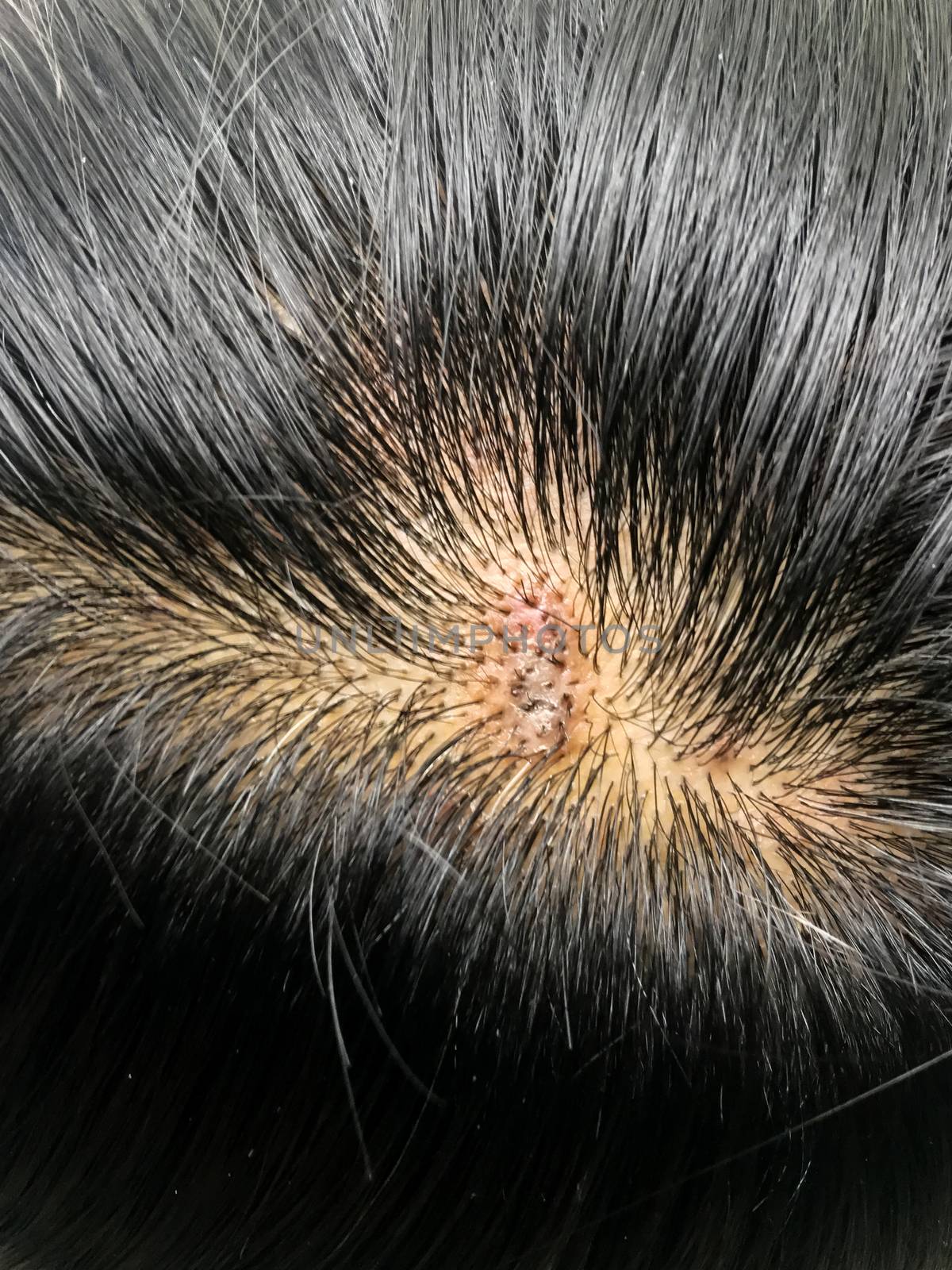 Close-up of black hair of Asians with hair and mold health problems on scalp.