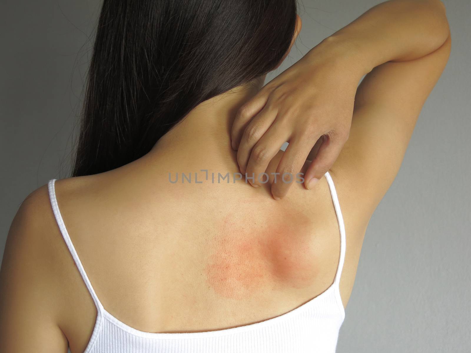 Health allergy skin care problem. Closeup young woman scratching her itchy back with allergy rash by asiandelight