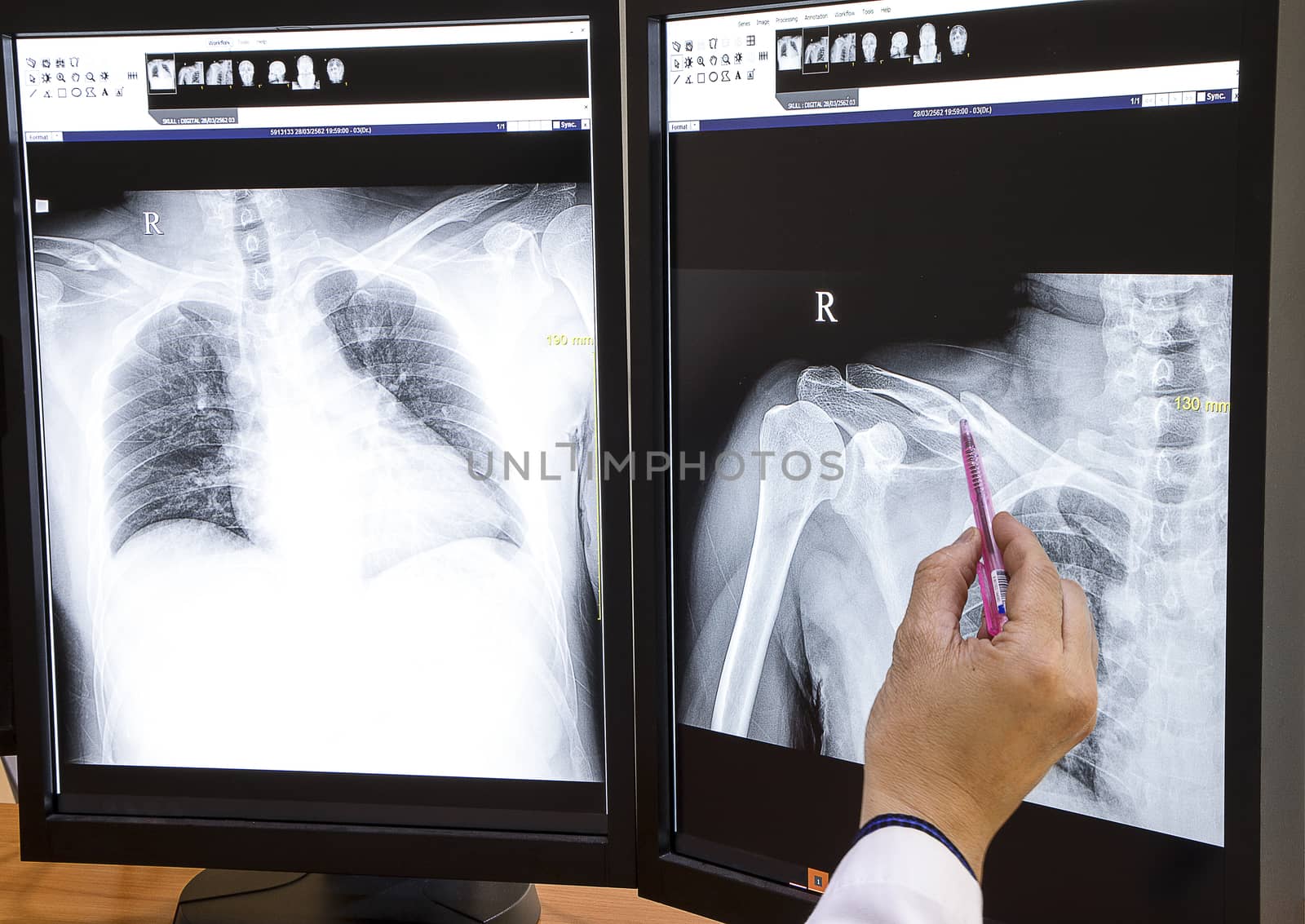 A medical doctor checking at xray images on a large double screen computer workstation. The patient has traumatic fracture of right clavicle and right ribs.