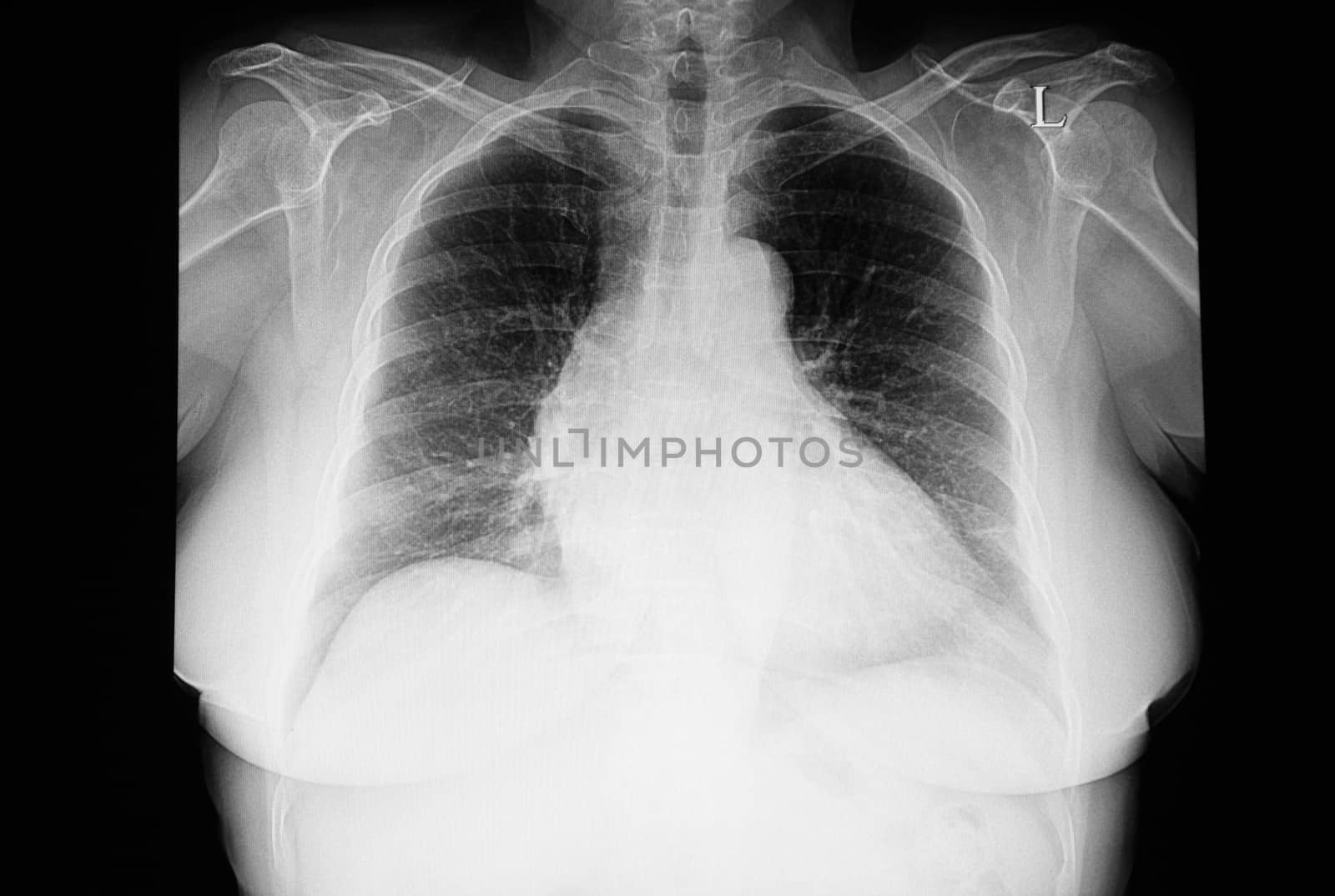 A chest xray film of a patient with cardiomegaly. Moderate degree of congestion is noted. Chest radiology image in disease.