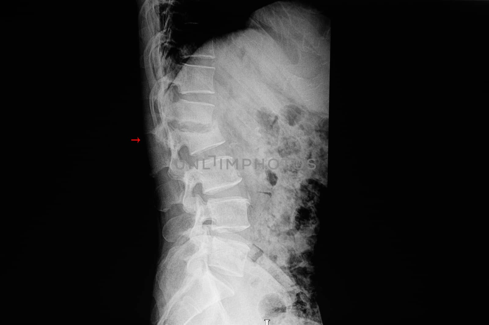 Xray film of a patient with back pain showing compression fracture of L2 vertebral body.