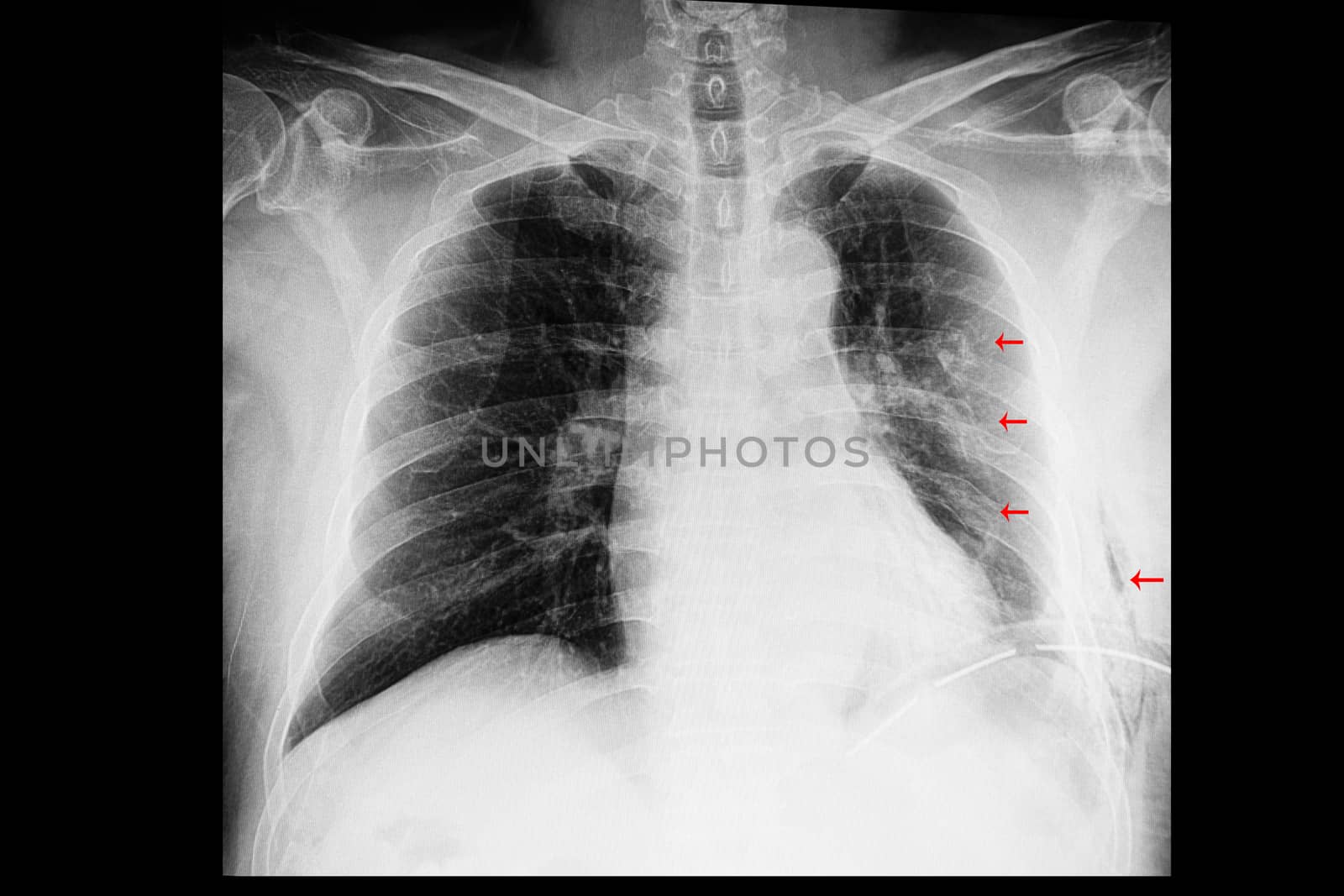 A chest xray film of a patient with old multiple left rib fractures with left side pleural effusion and an intrathoracic drainage tube (ICD). Left subcutaneous emphysema is also presented.