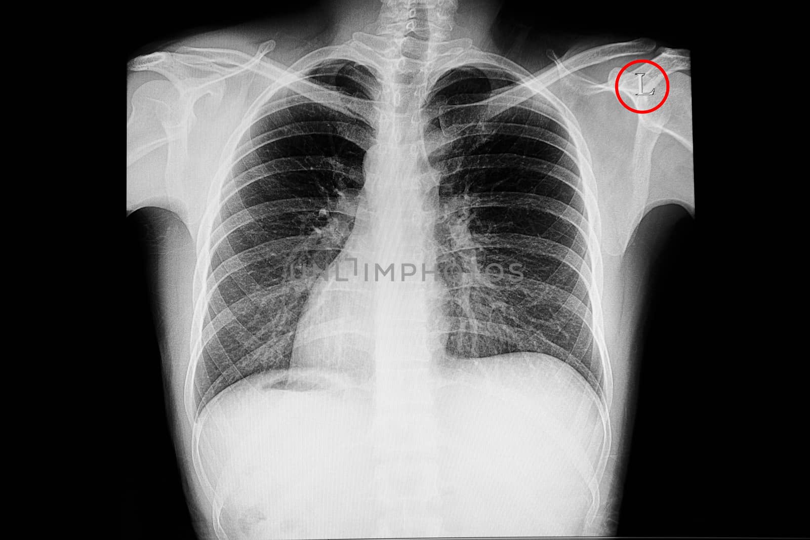 Chest x-ray showing situs inversus (situs transversus or oppositus), a congenital condition in which the major visceral organs are reversed or mirrored from their normal positions. In this case the cardiac shadow is s on the right side