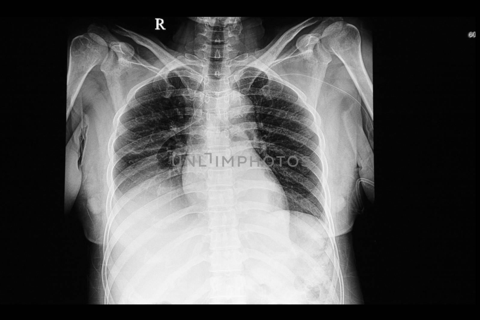 A chest xray film of a patient with pulmonary edema, cephalizaion, and pleural effusions. of both lungs. A right heart venous catheter is also shown.