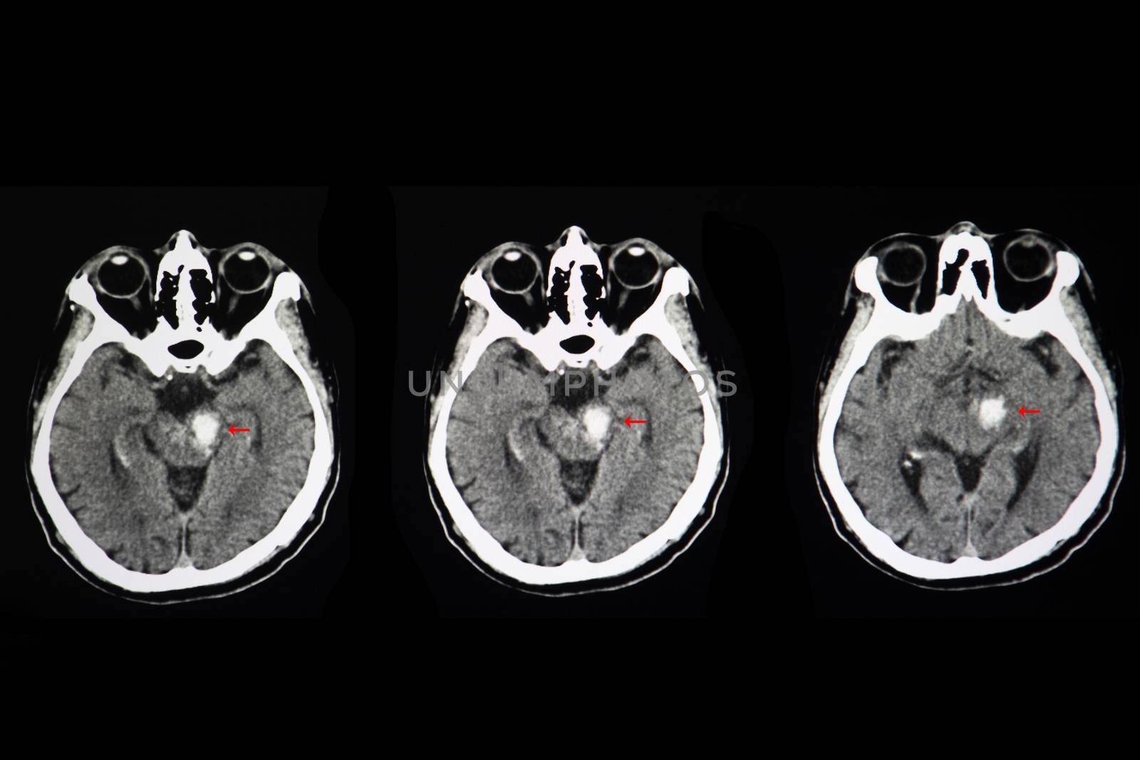 CT scan of the brain of a patient suffers from acute stroke showing white areas of large brain stem hemorrhage. Axial section.