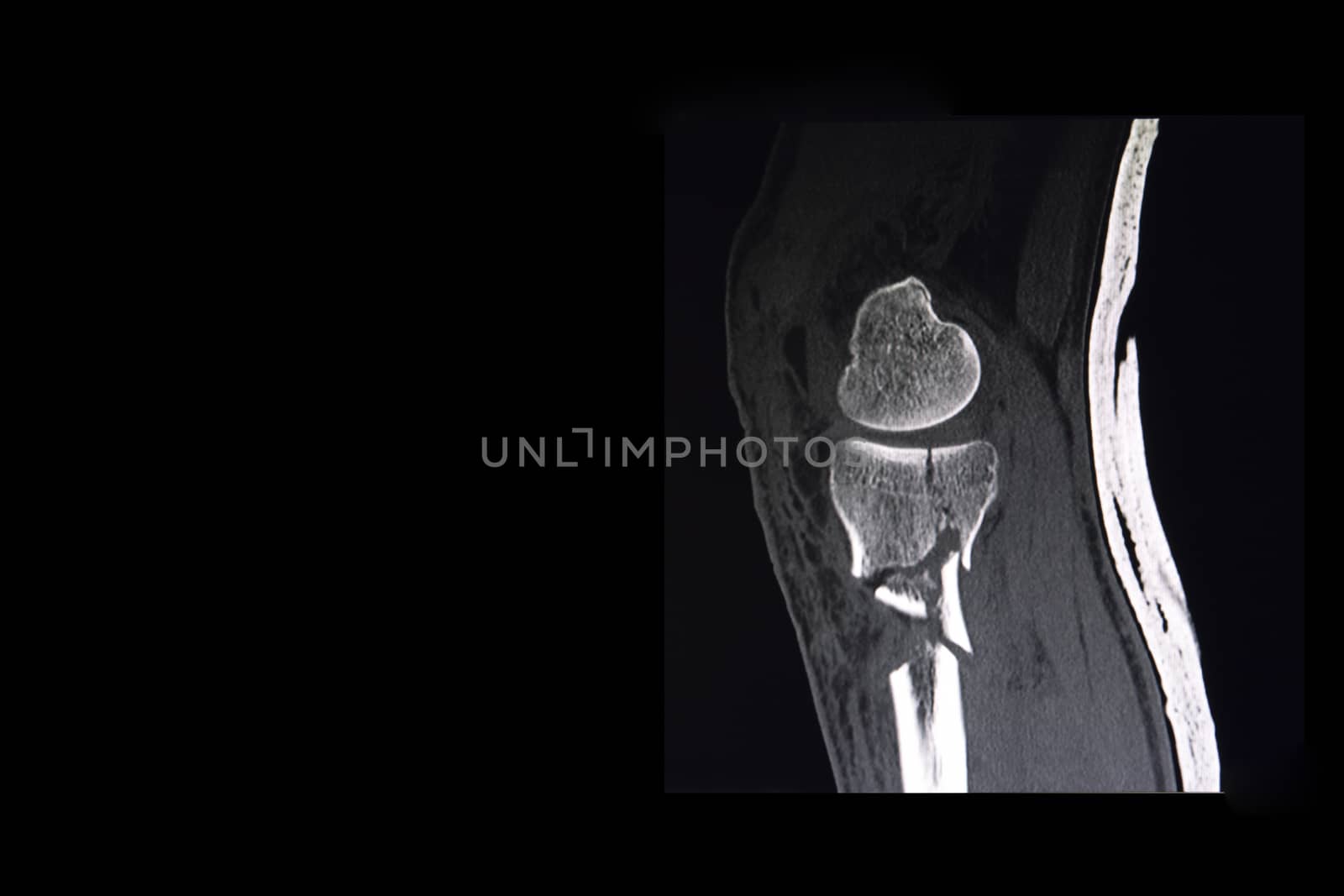 CT scan of a knee of the patient showing comminuted fracture of tibial plateau and proximal tibia.