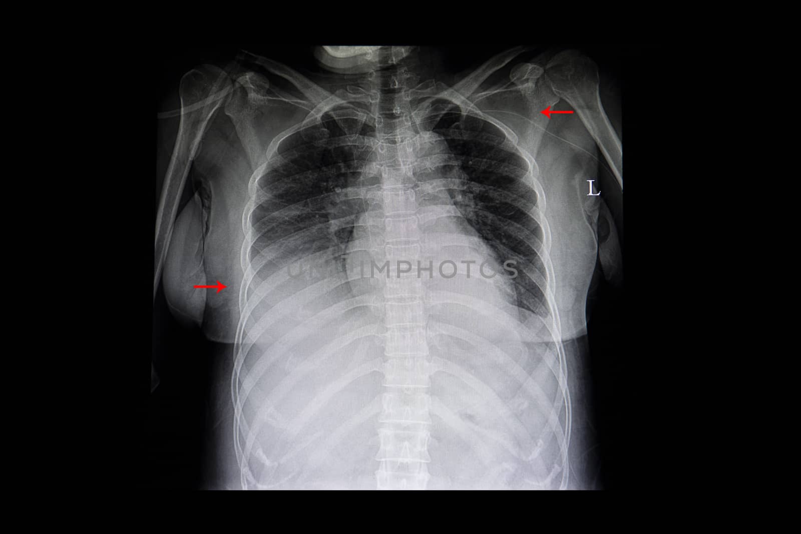 A chest xray film of a patient with right lower lung infiltration. A venous catheter is placed in the right ventricle. Severe pulmonary infection.