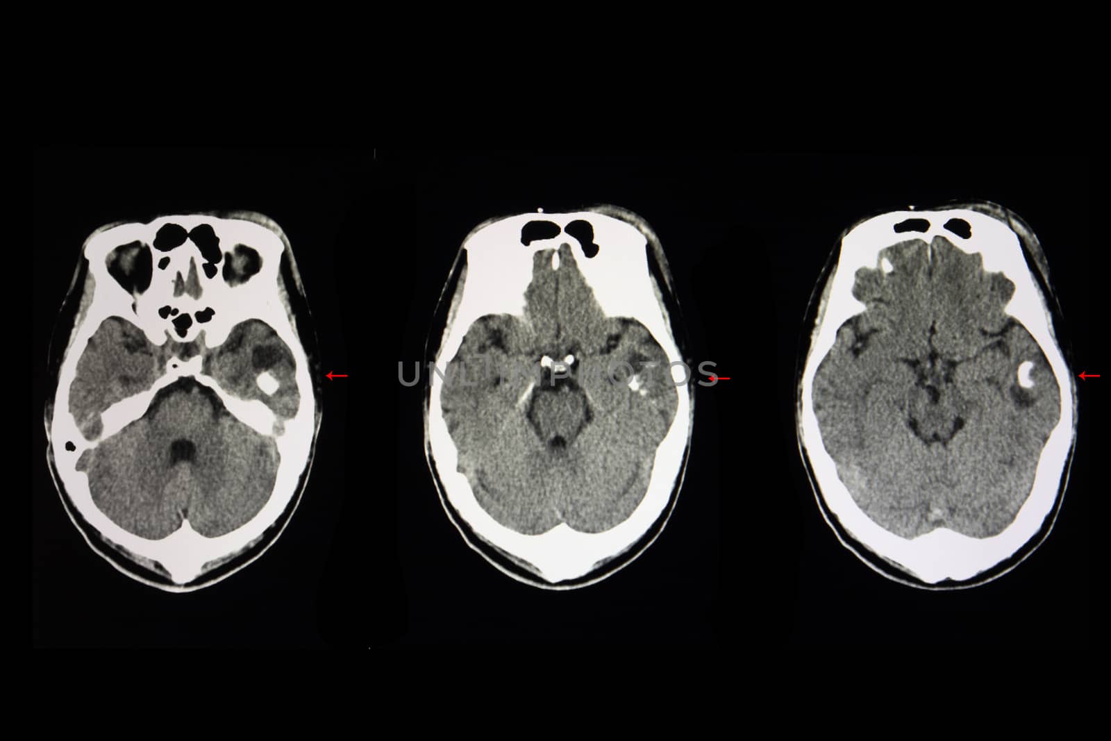 A CT brain with radiopaque material injected. A large cyctic tumor with internal enhancing lesions is shown in the left temporal lobe. CT scan of a malignant brain cancer.