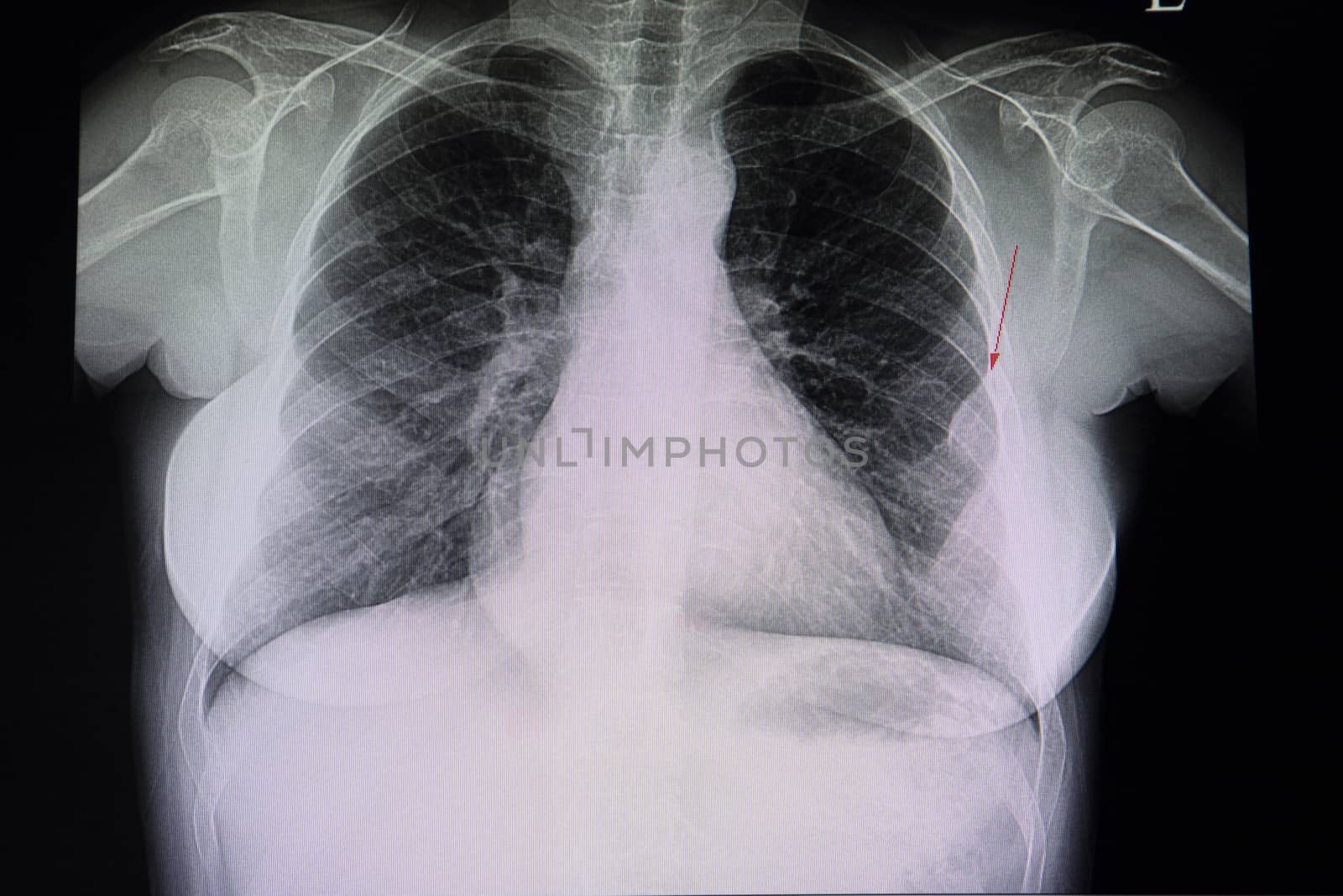 A chest xray film of a patient with a focal pleural lesion in his left middle lung. A case of abnormal x ray.