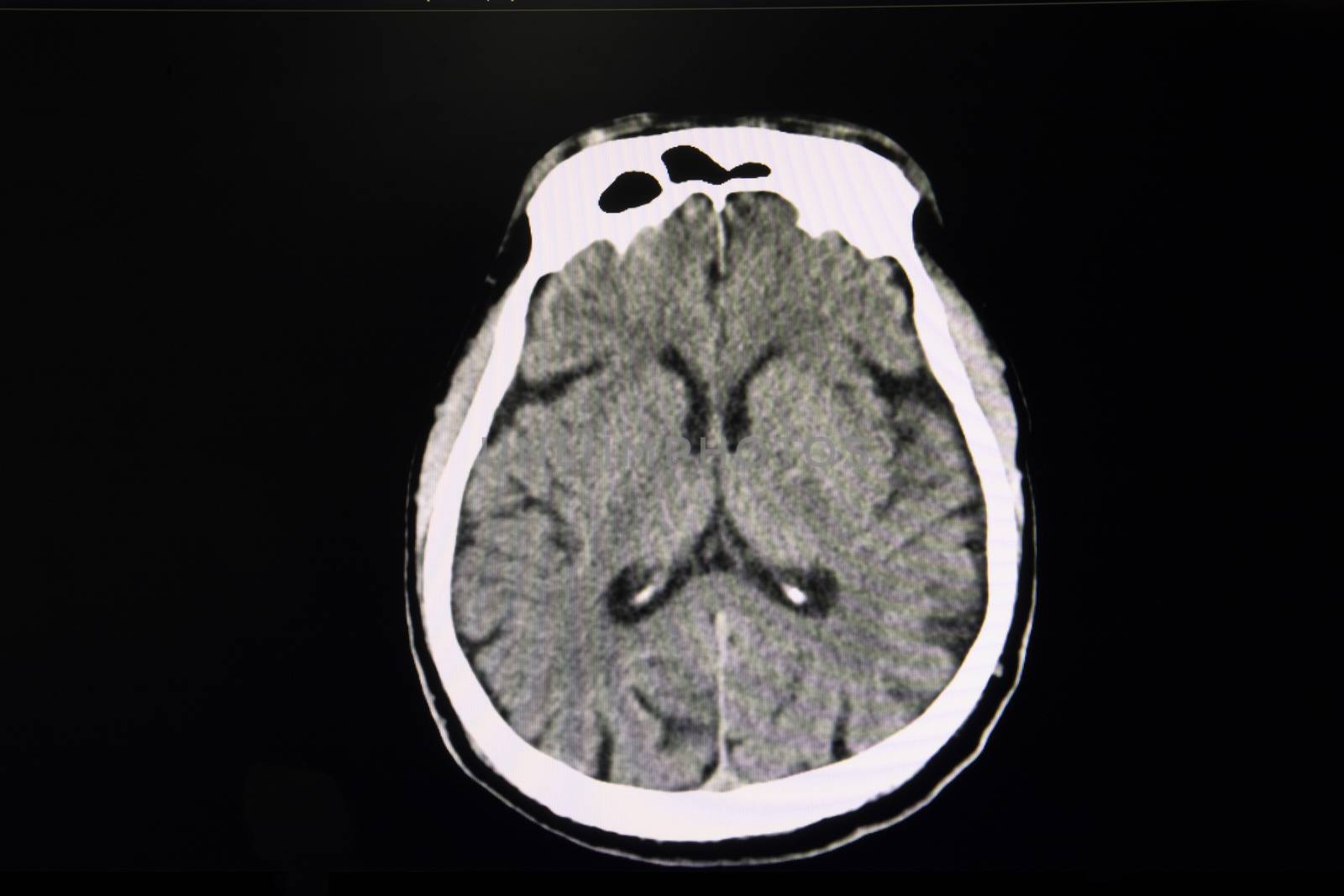 CT scan of the brain of a patient suffers from acute stroke showing moderate brain atrophy. Axial section.
