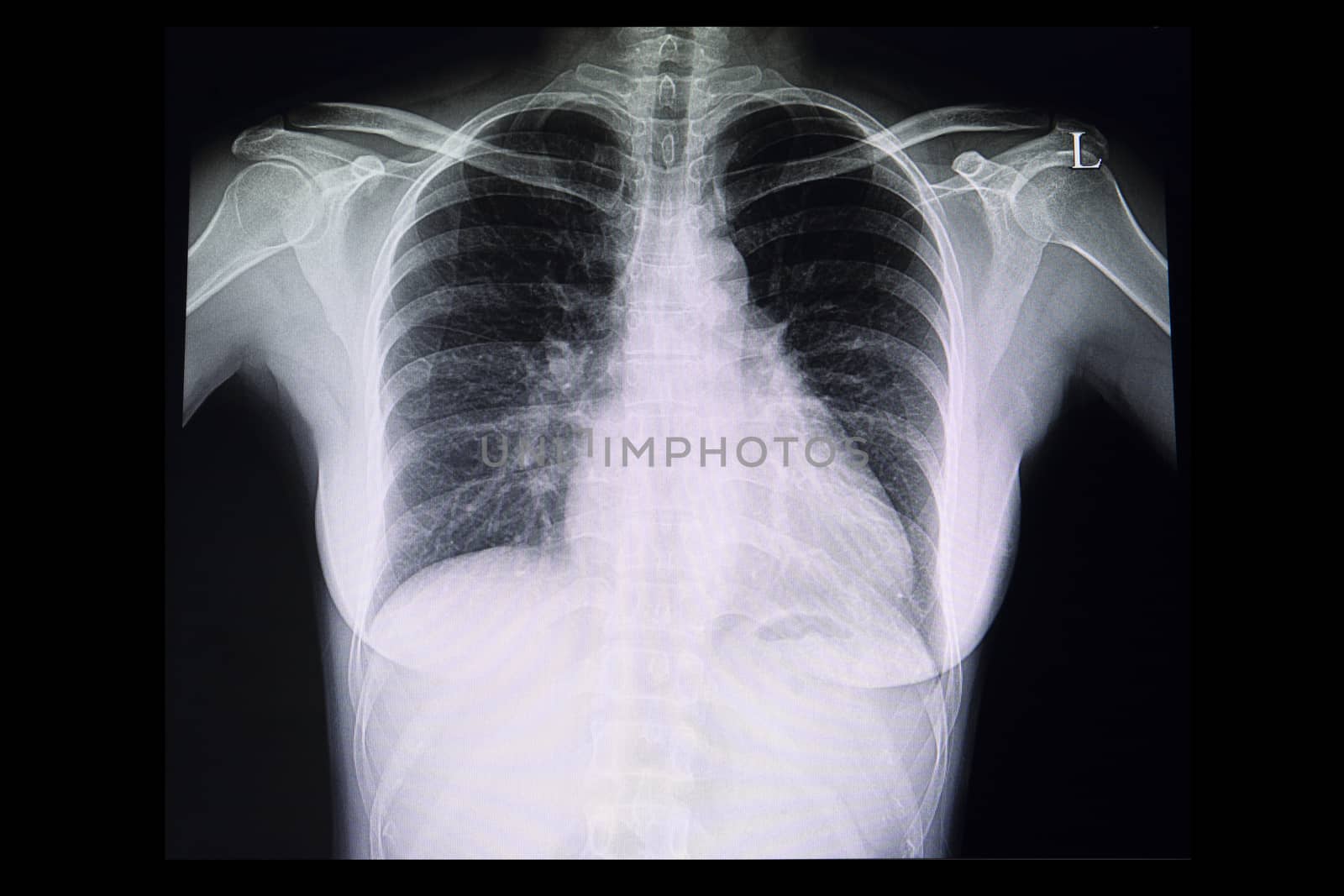 A chest xray film of a patient with cardiomegaly or enlarged heart. A case of abnormal x ray.