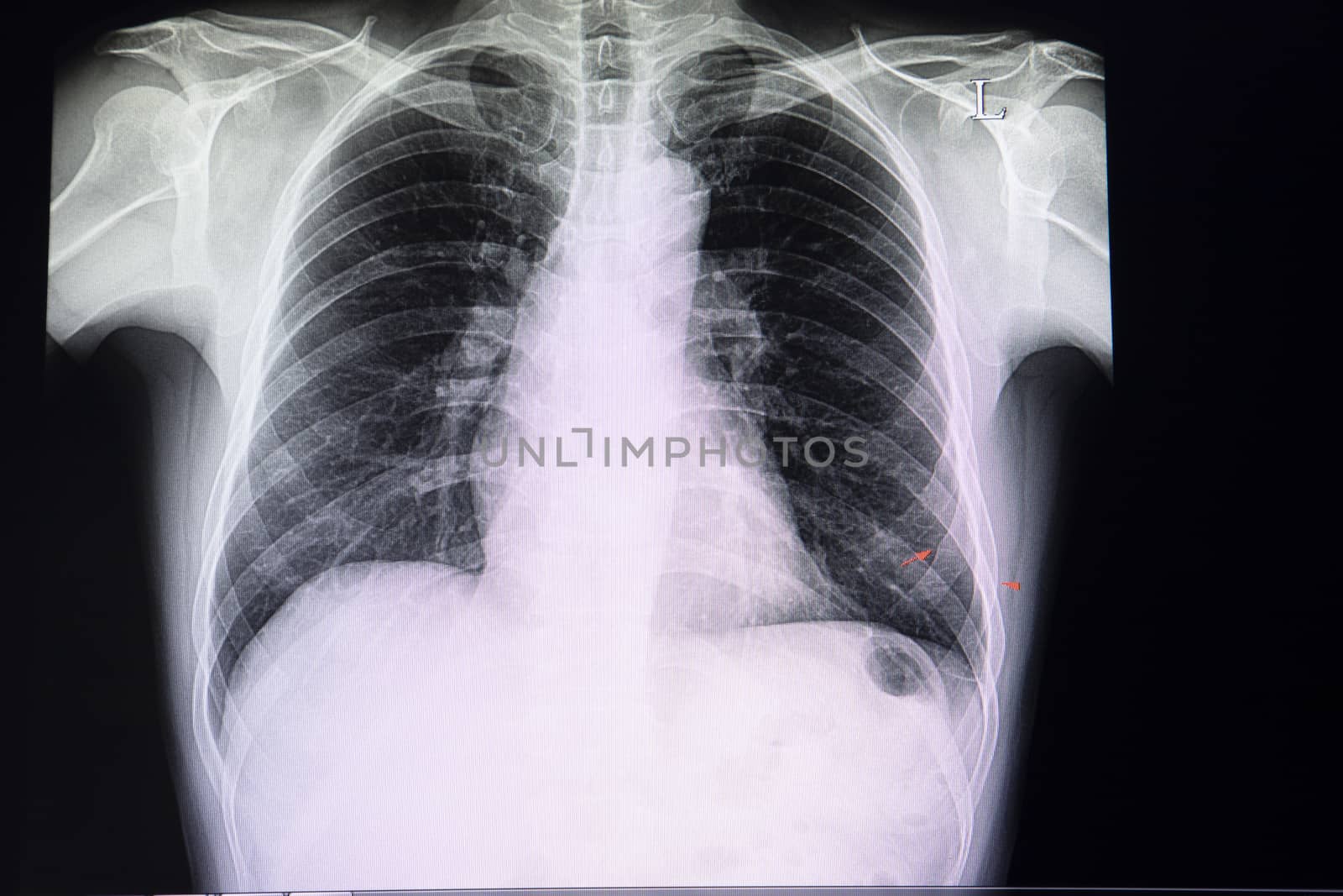 A chest xray film of a patient with old fractures on lateral ribs 7-8. A case of abnormal x ray. Pulmonary tumor suspected.