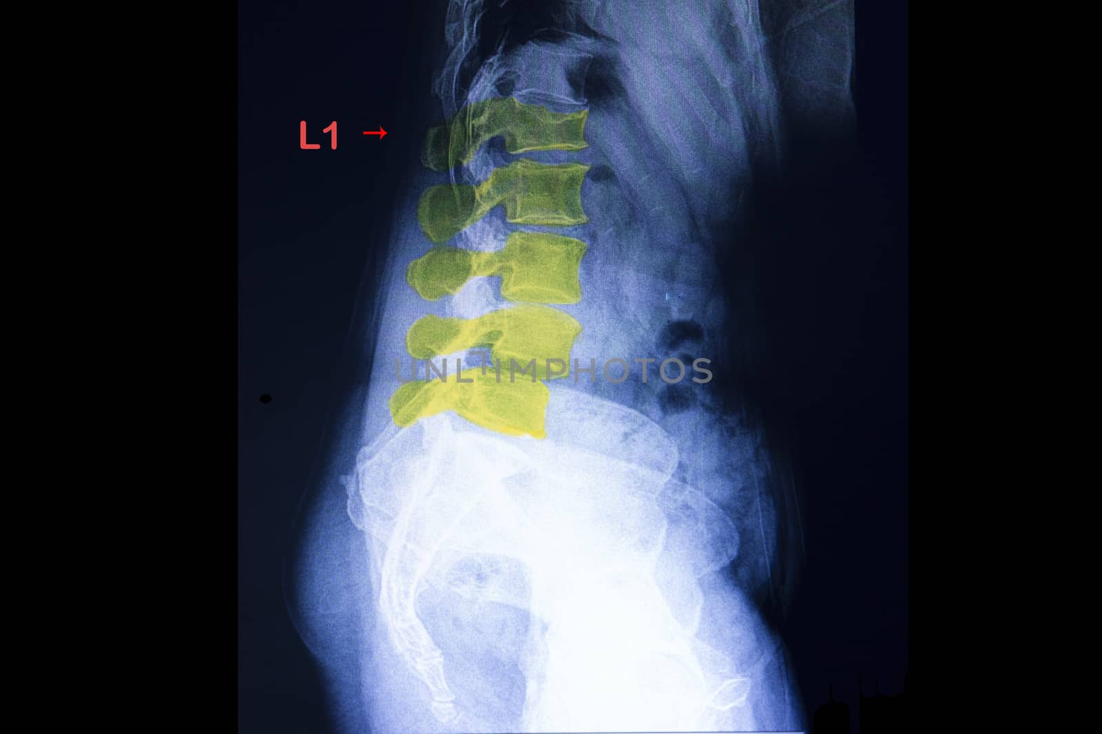 Xray film of a patient with back pain showing anterior spondylolithesis of L4 on L5 and compression fracture of L1 vertebral body. A case of abnormal x ray.