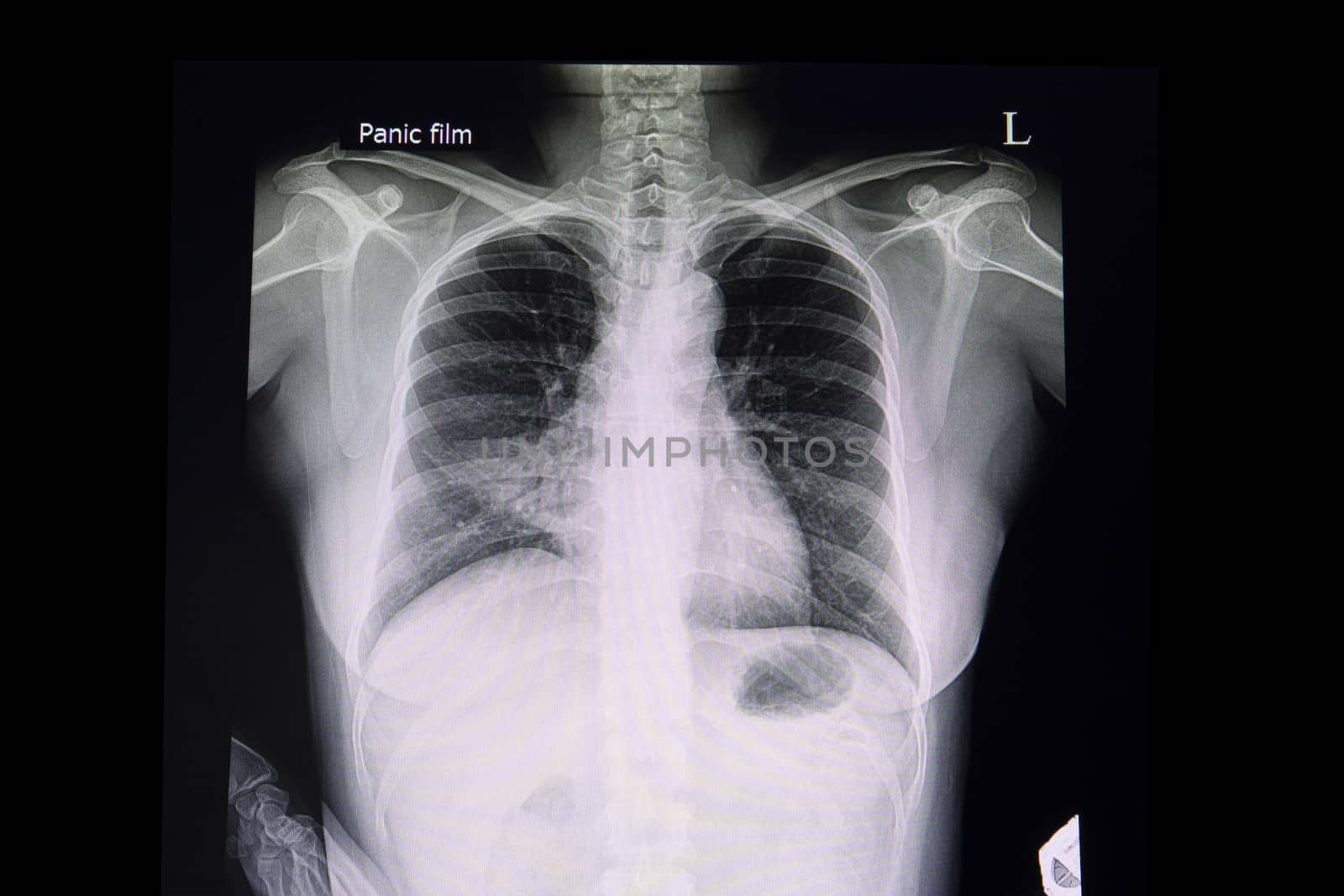 A chest xray film of a patient with pneumonia in his right middle lung. A case of abnormal x ray. Bacterial infection suspected.