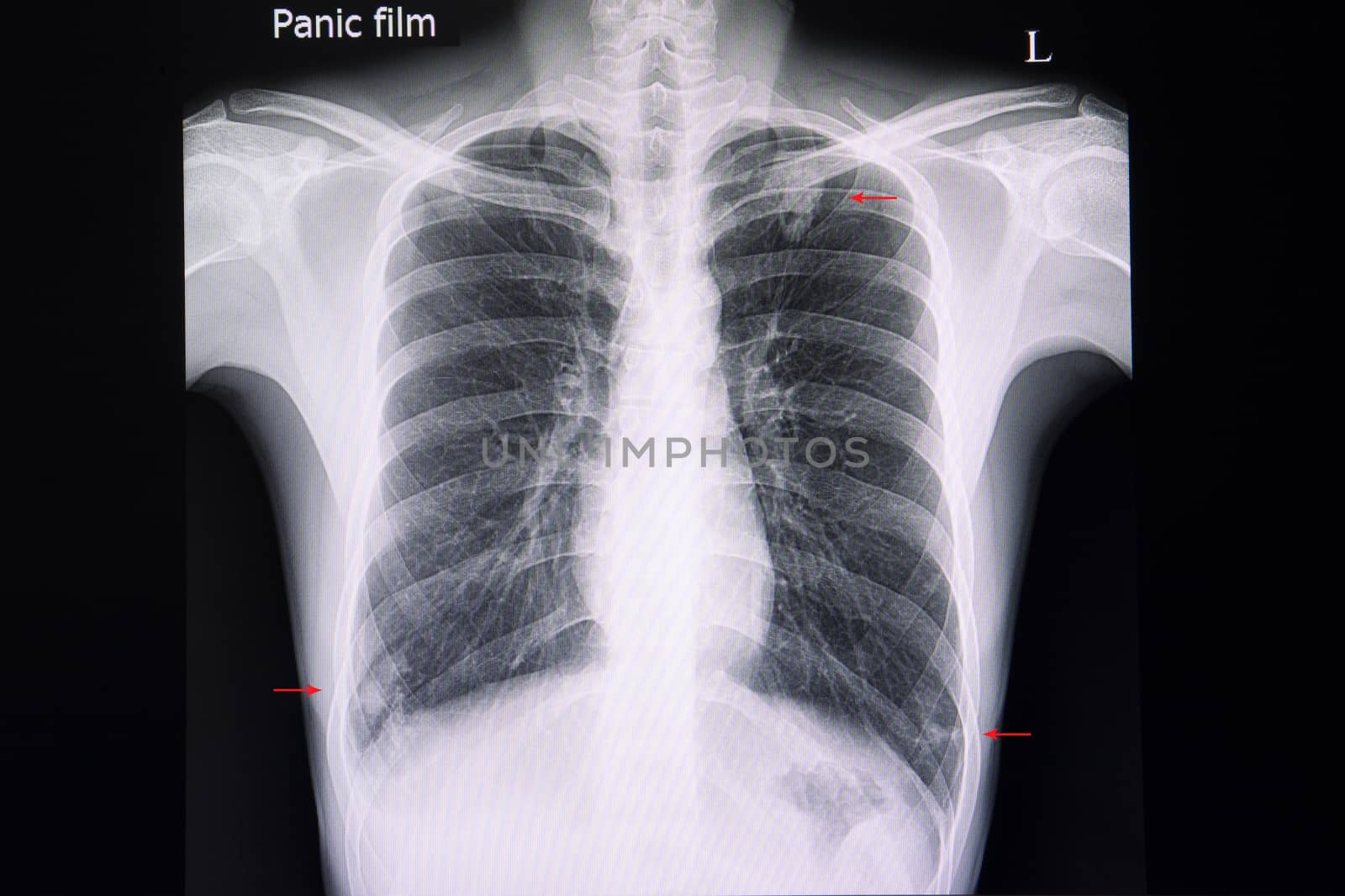 a chest xray with multiple nodular infiltrations in the lungs by Nawoot