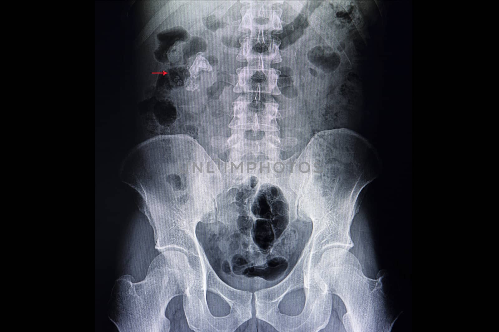 A kidney ureter bladder xray film or KUB film of a patient with large renal calculi or kidney stone in his right kidney. A case of abnormal x ray.