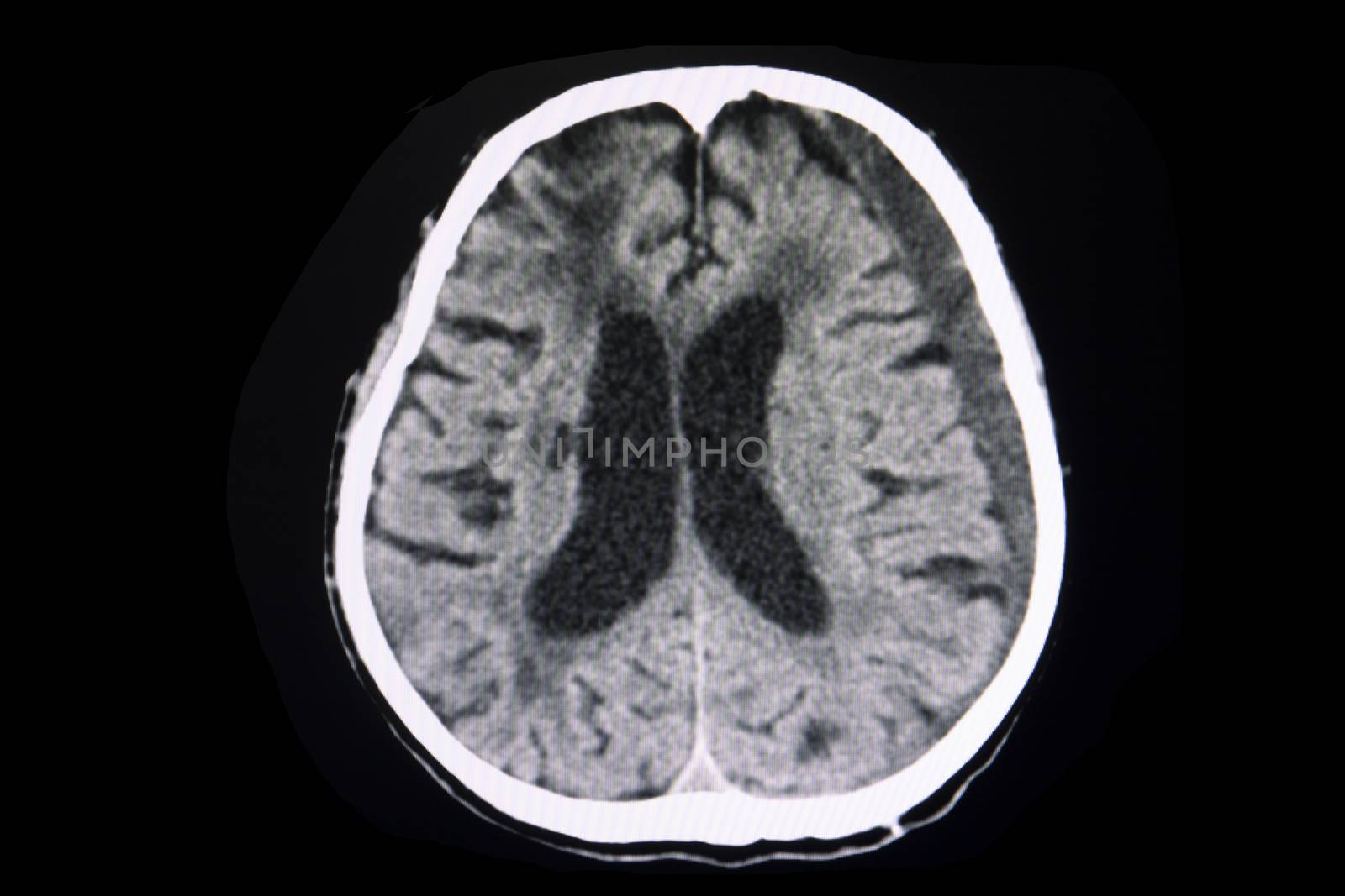 CT brain scan of a patient with history of mild head injyry for one month showing large aubacute subdural hematoma on left cerebral hemisphere.