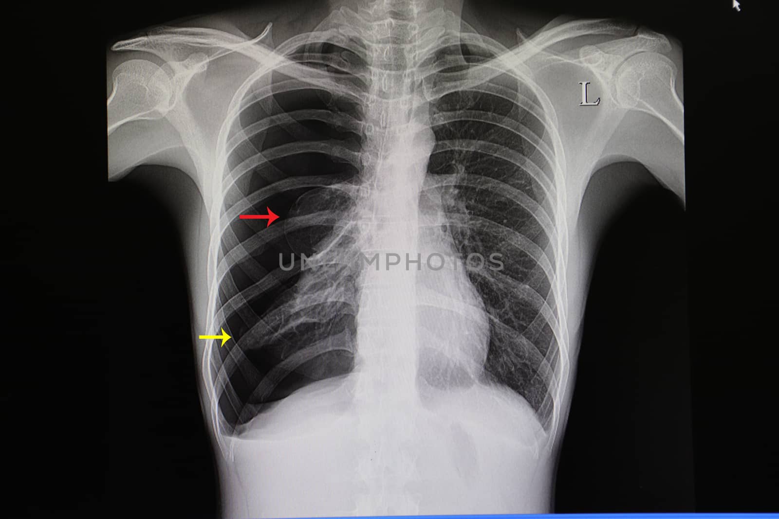 a chest xray film of a patient with large spontaneous pneumothorax with almost total right lung collapse (yellow arrow), a lung bleb is also shown (red arfrow)