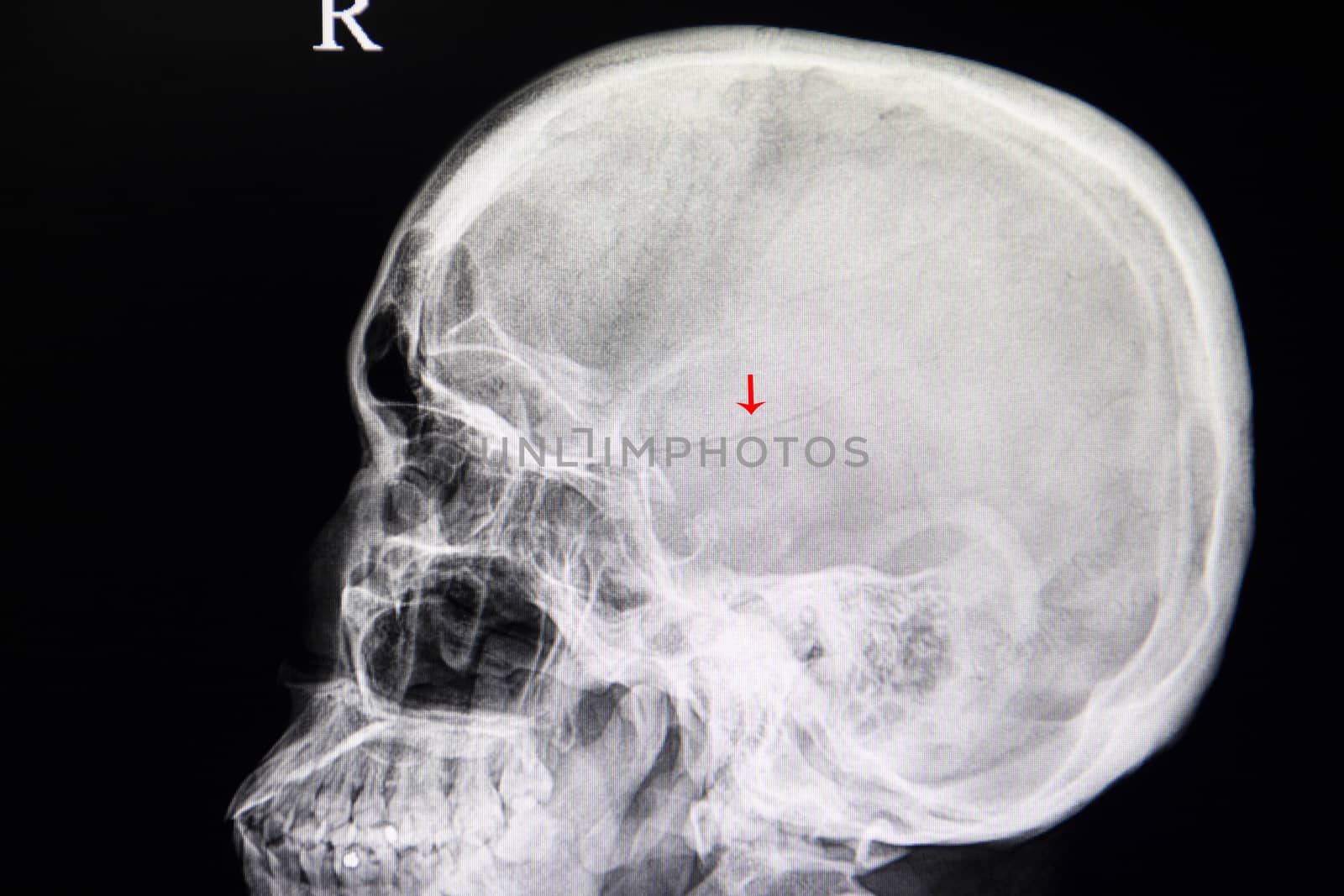 A skull xray film of a traumatic brain injury patient showing a temporoparietal linear fracture of the skull.