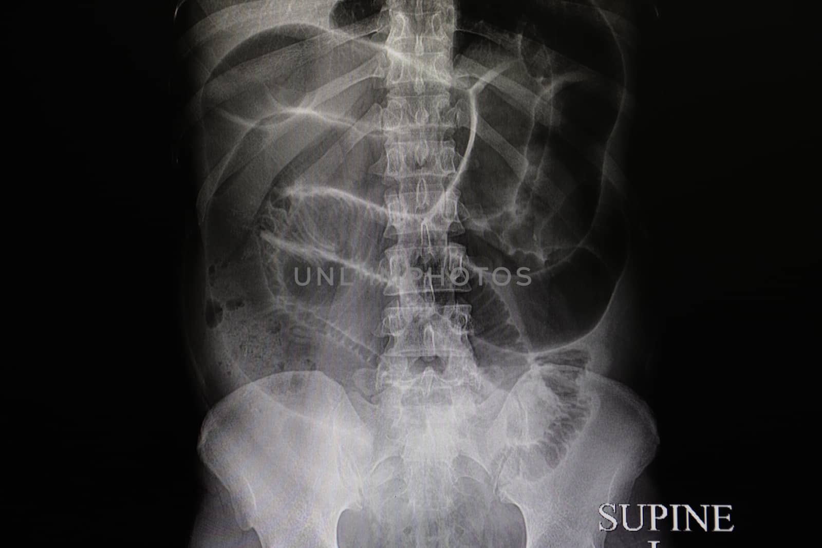 an abdominal xray film of a patient with complete large intestinal obstruction, shown with dilated loops of large and small bowels