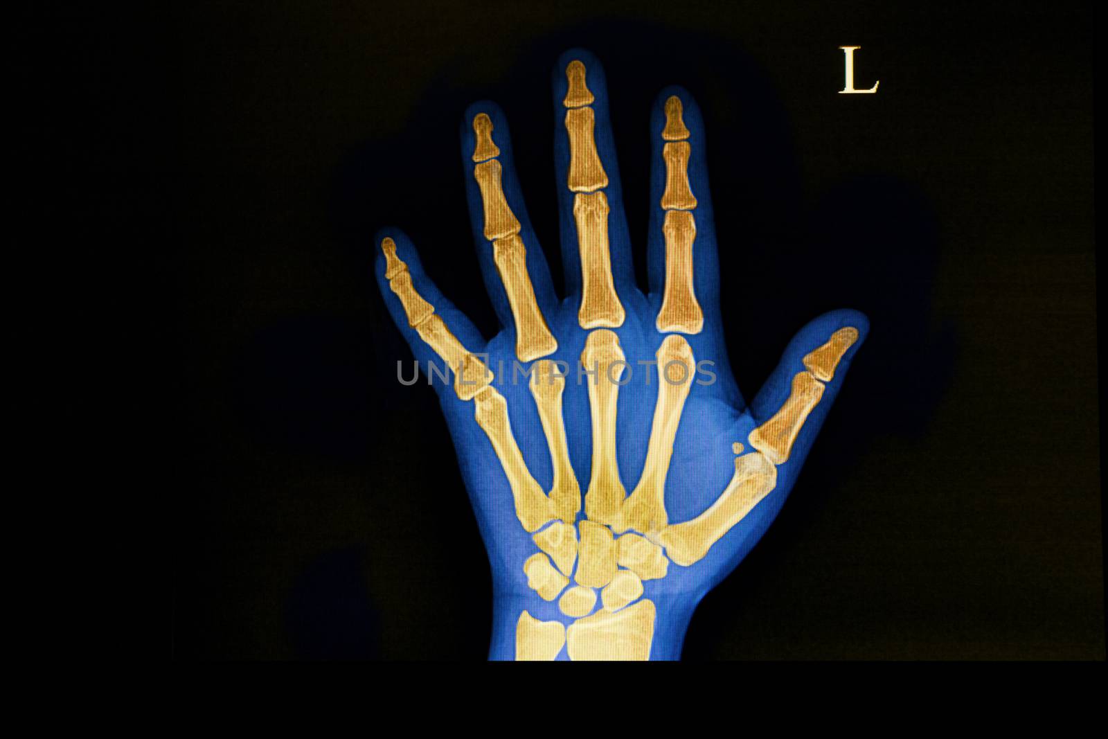 A hand x ray film of a patient with traumatic fracture of the base of his fifth metacarpal bone. The fracture site is easily seen through color enhancement of the bony structures.