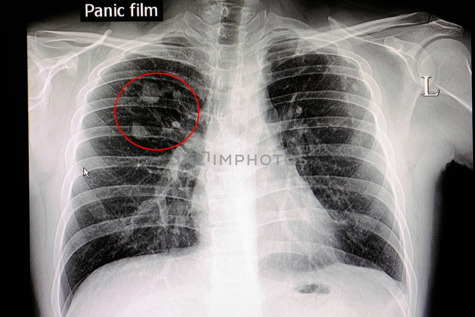 Xray film of a patient with lung nodules in his right upper lung