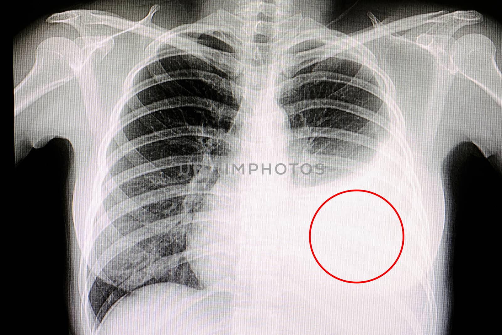 Xray film of a patient with large pleural effusion