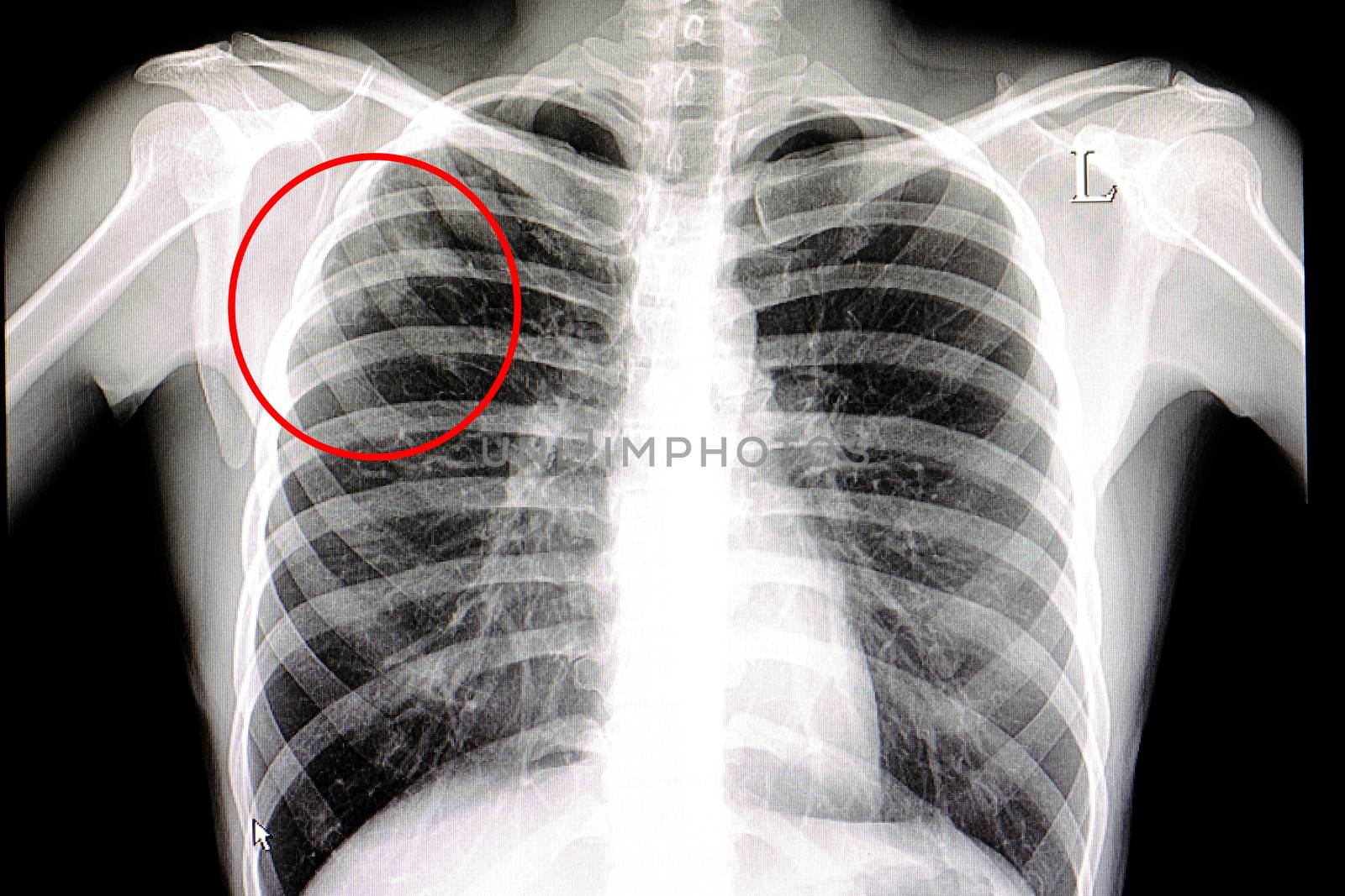 Xray film of a patient with pulmonary tuberculosis
