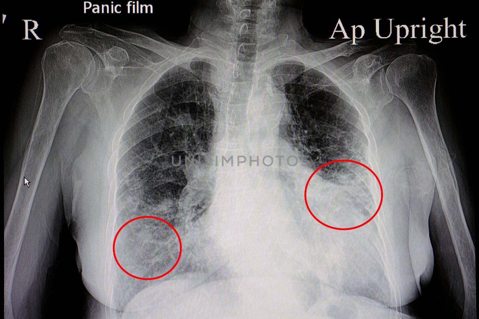 a chest x-ray film of a female patient showing cardiomegaly and bilateral pulmonary congestion